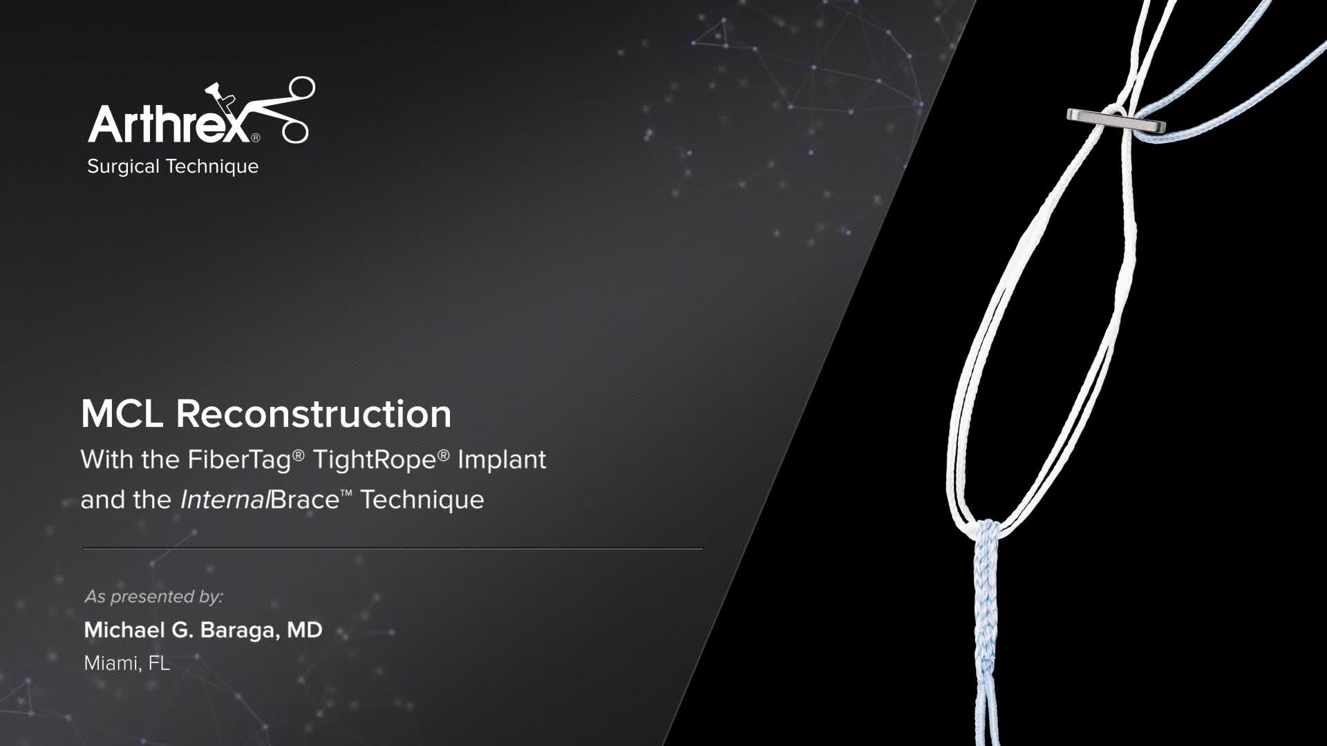 Arthrex - MCL Reconstruction With the FiberTag® TightRope® Implant