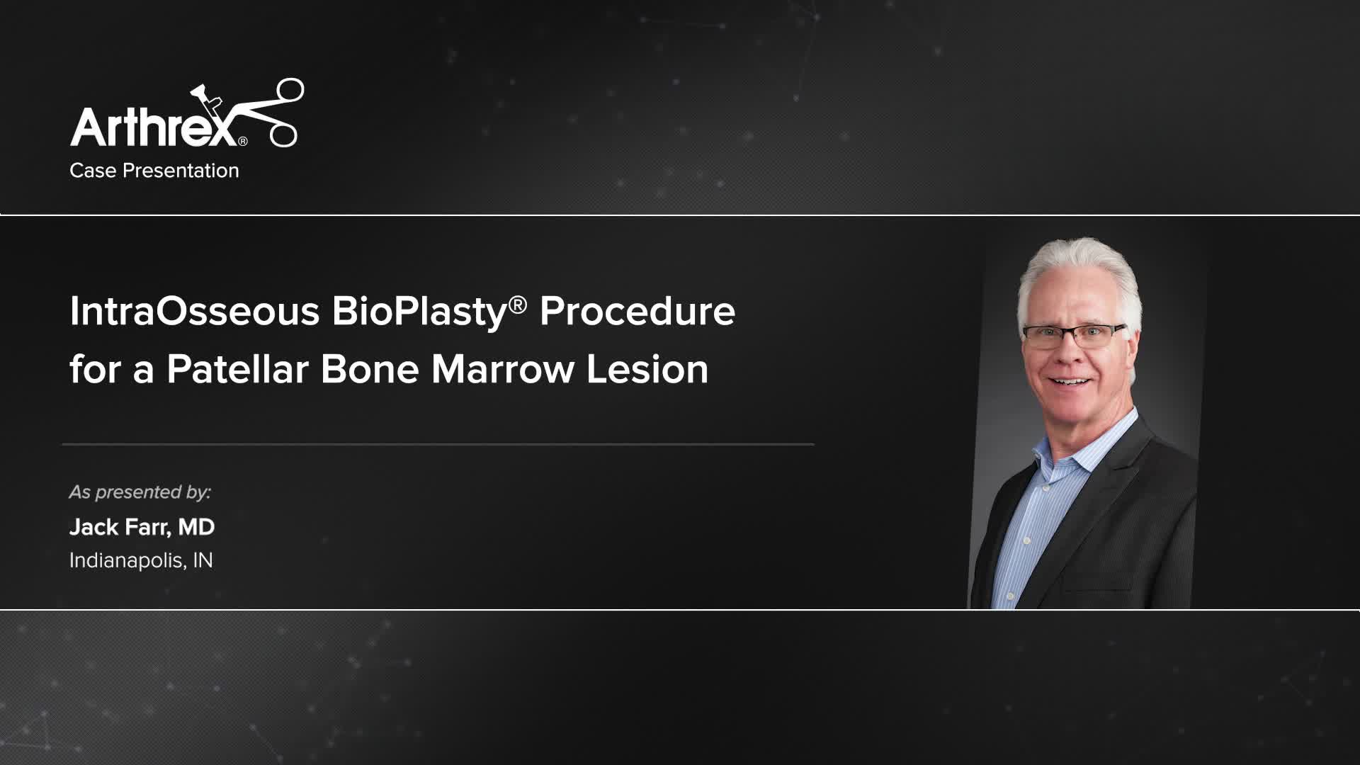 Arthrex - IntraOsseous BioPlasty® Procedure For A Patellar Bone Marrow ...