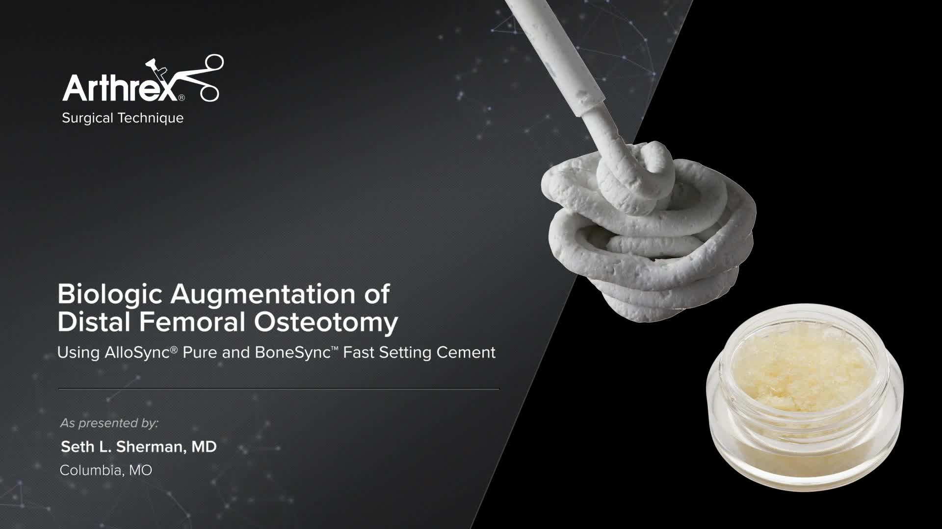 Arthrex Biologic Augmentation Of Distal Femoral Osteotomy Using Allosync Pure And Bonesync