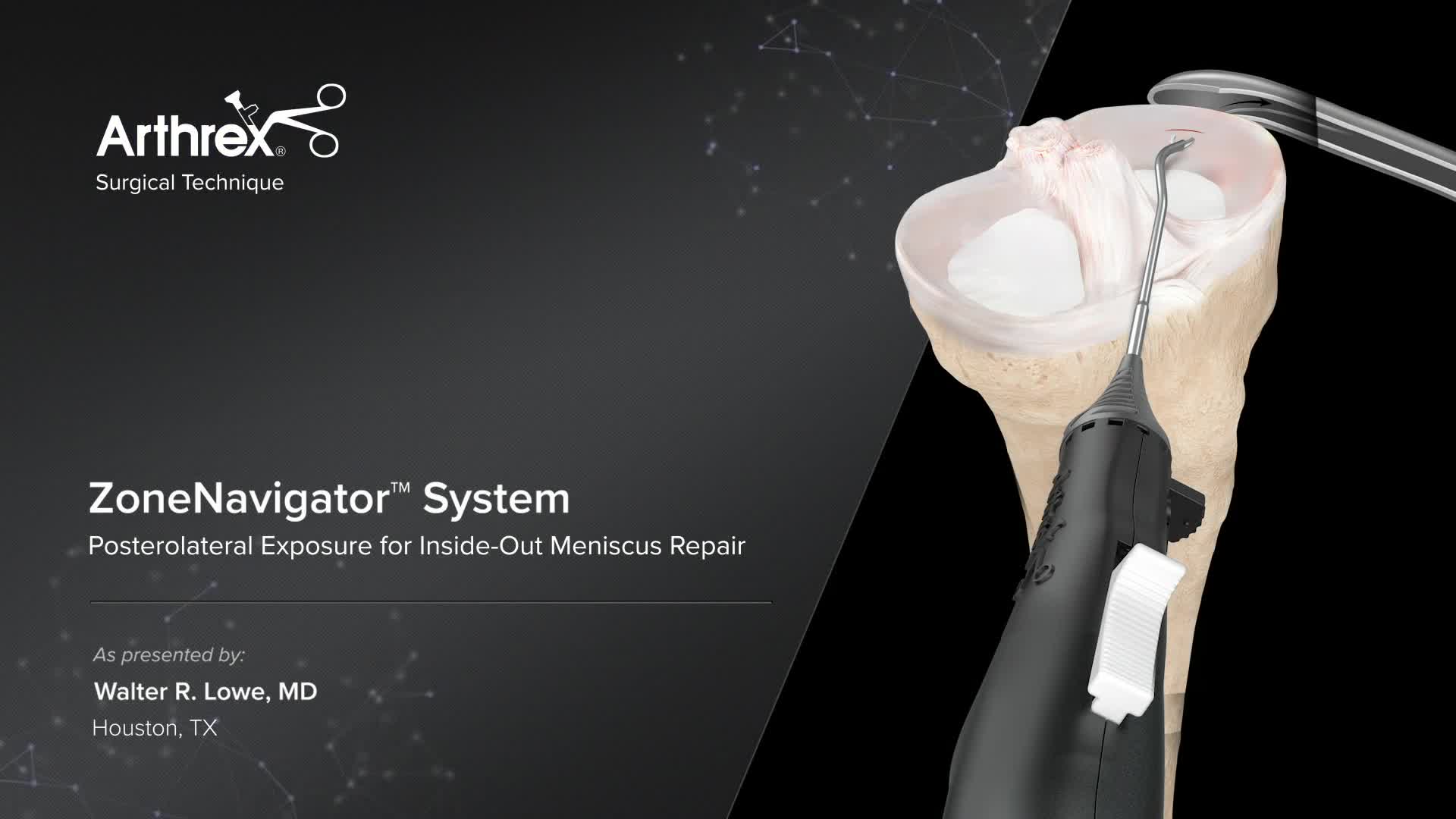 Arthrex Zonenavigator System Posterolateral Exposure For Inside Out Meniscus Repair