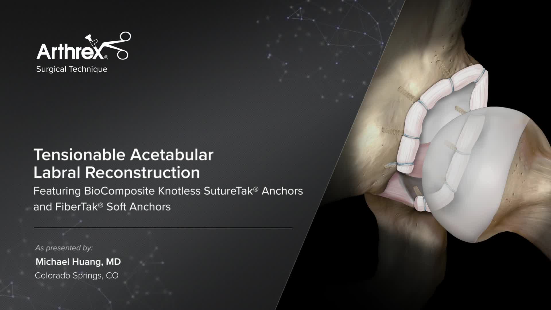 Arthrex Tensionable Acetabular Labral Reconstruction Featuring