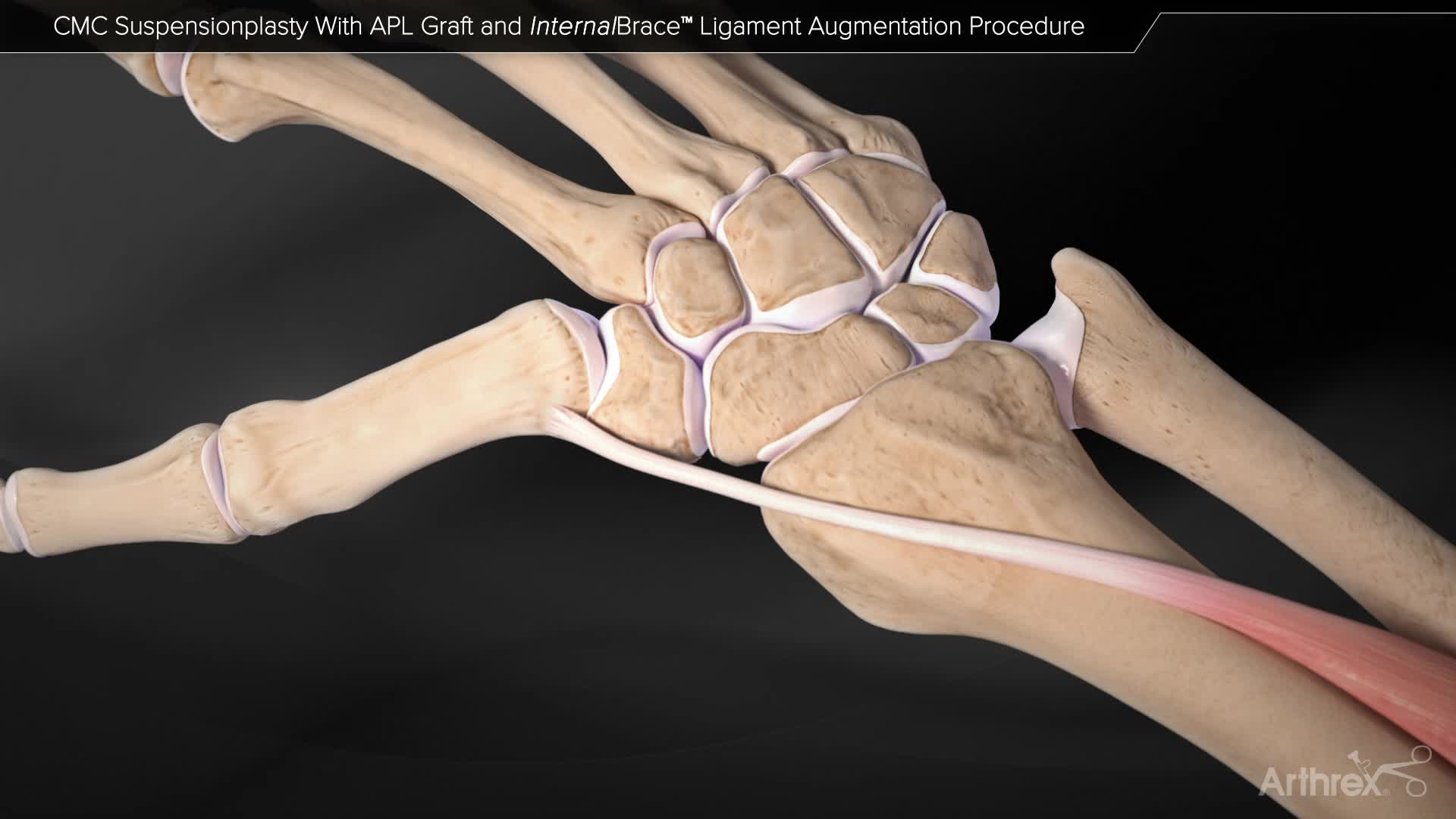 Arthrex Cmc Suspensionplasty With Apl Graft And Internalbrace™ Ligament Augmentation Procedure 6279