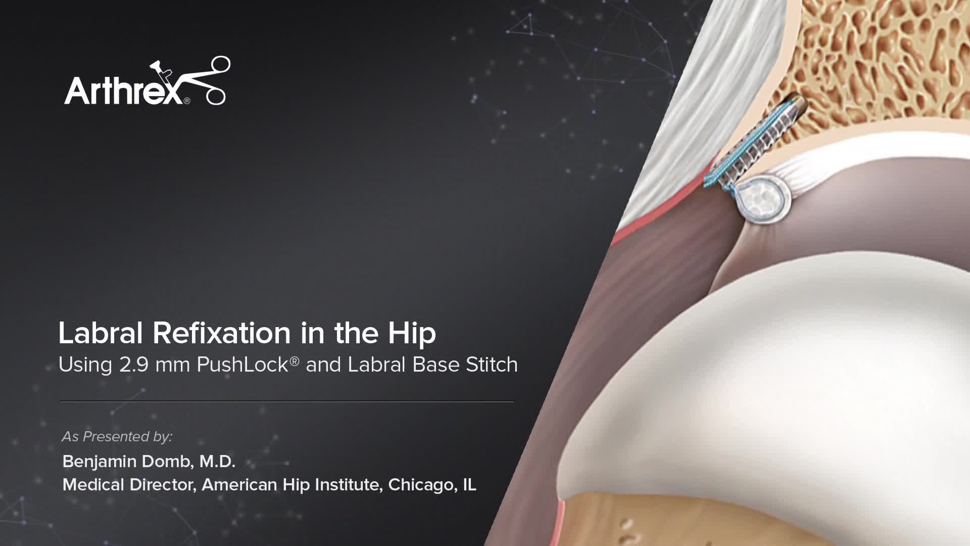 Arthrex - Labral Hip Refixation