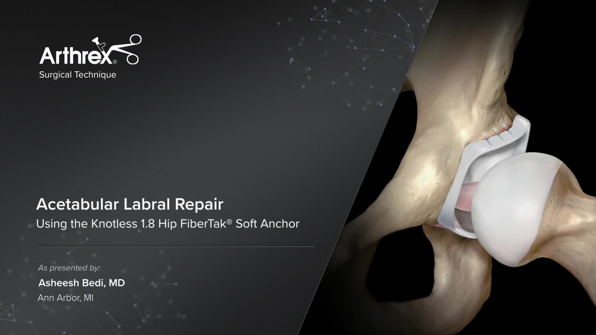 Arthrex - Acetabular Labral Repair Using the Knotless 1.8 Hip FiberTak ...