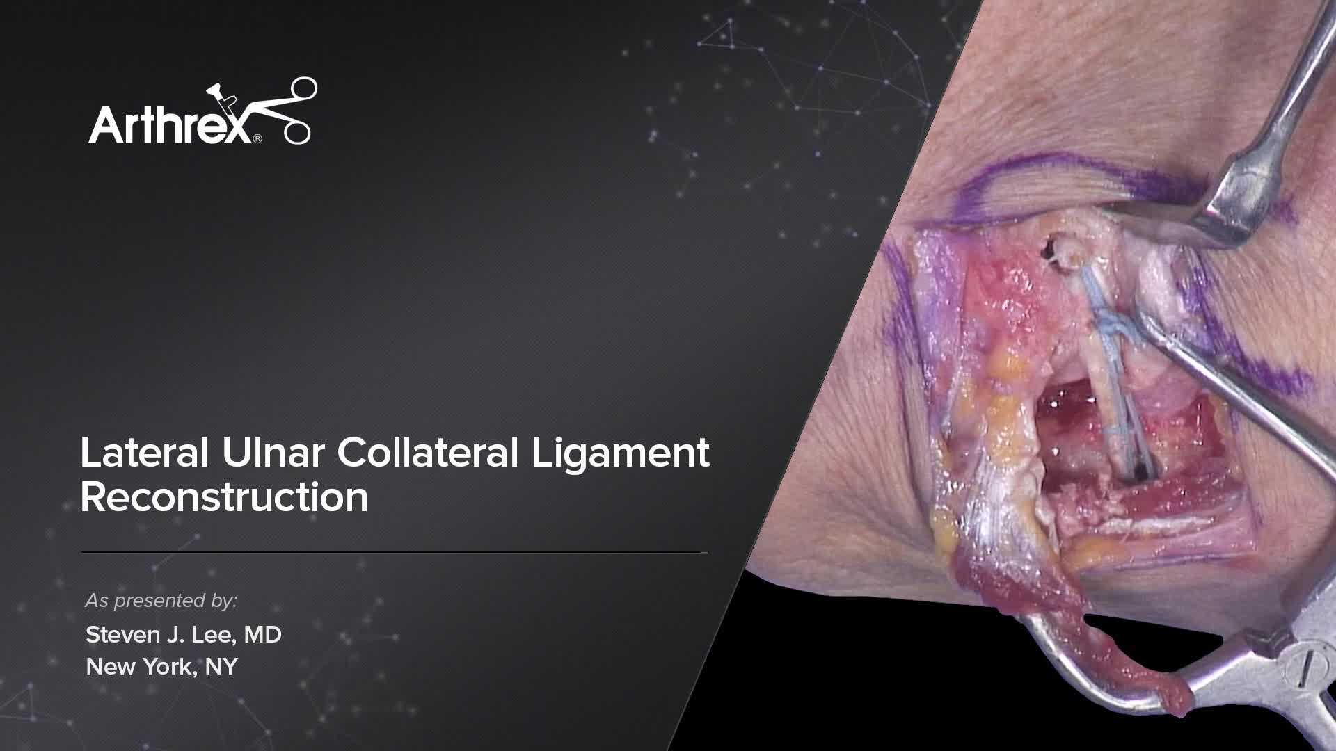 Arthrex Lateral Ulnar Collateral Ligament Reconstruction