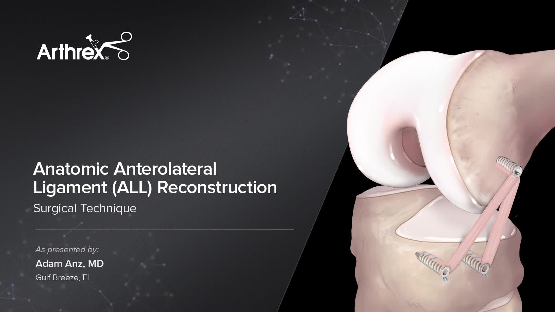 Arthrex - Anatomic Anterolateral Ligament (ALL) Reconstruction