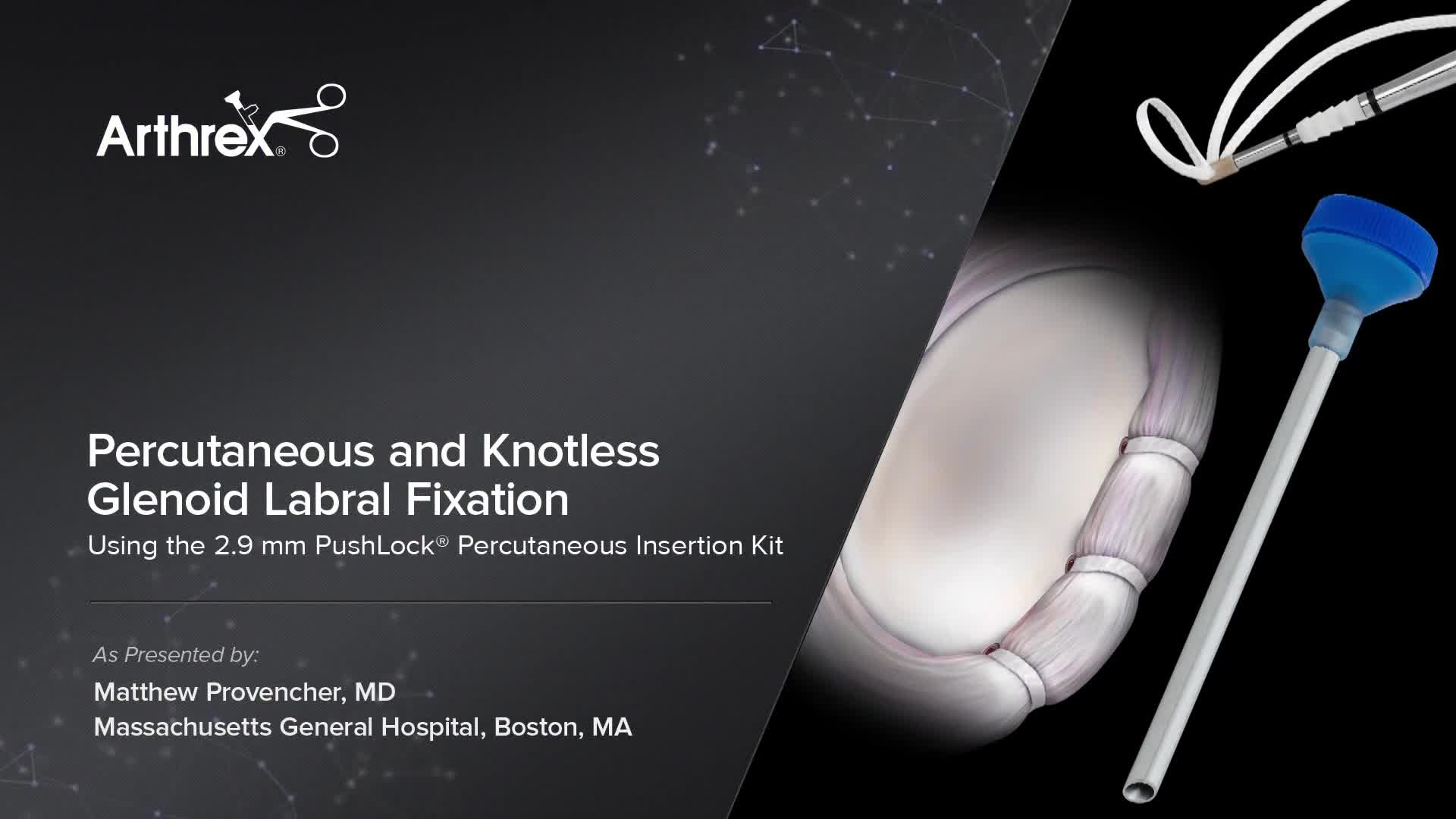 Arthrex Percutaneous And Knotless Glenoid Labral Fixation Using The