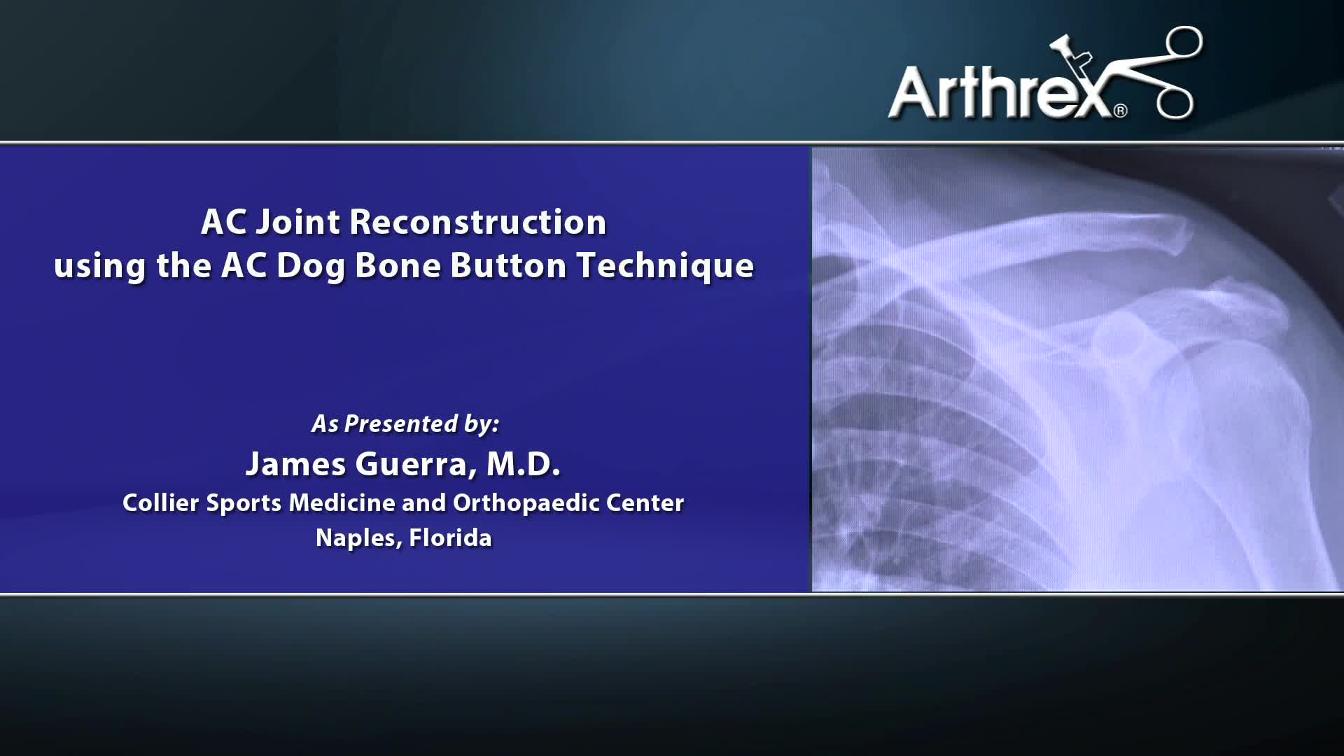 Arthrex - AC Joint Reconstruction Using the Dog Bone™ Button Technique