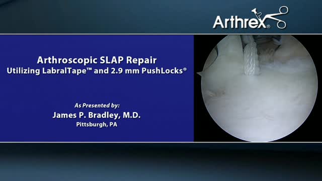 Arthrex Arthroscopic Slap Repair Utilizing Labraltape And Mm