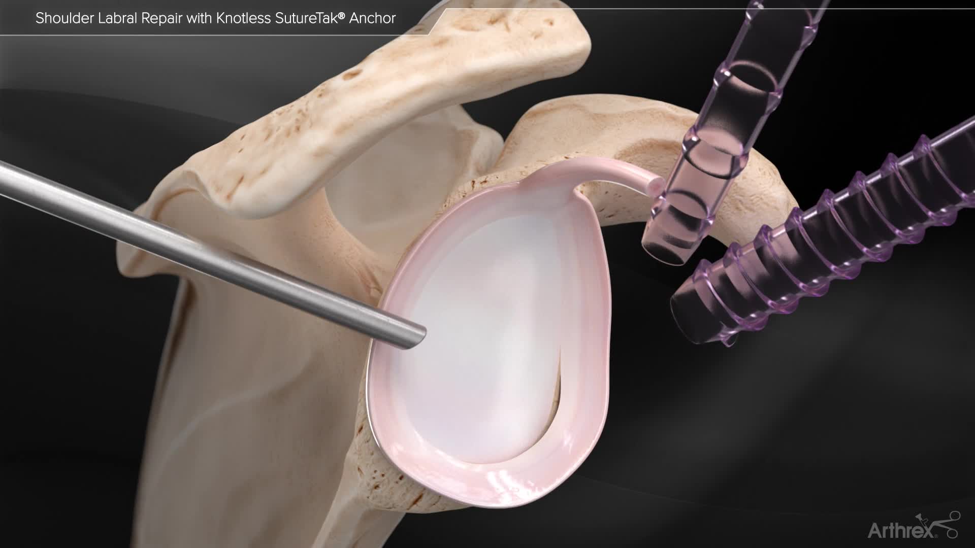 Arthrex Shoulder Labral Repair With Knotless SutureTak Anchor