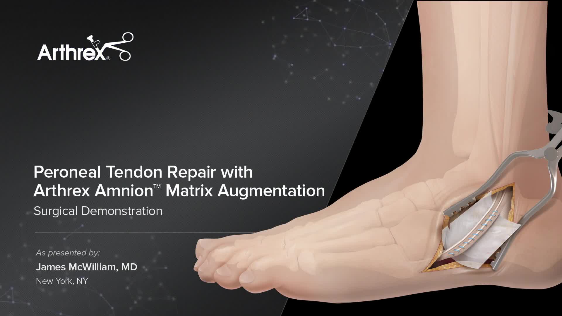 Arthrex Peroneal Tendon Repair With Arthrex Amnion Matrix Augmentation