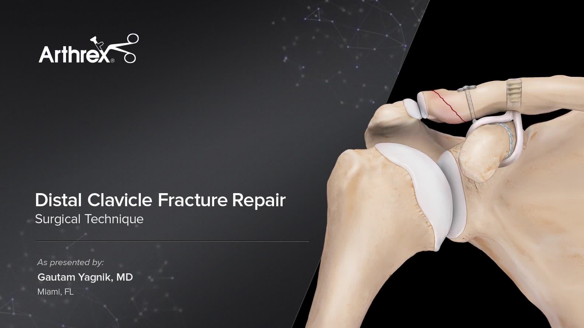 Arthrex Distal Clavicle Fracture Repair 8234