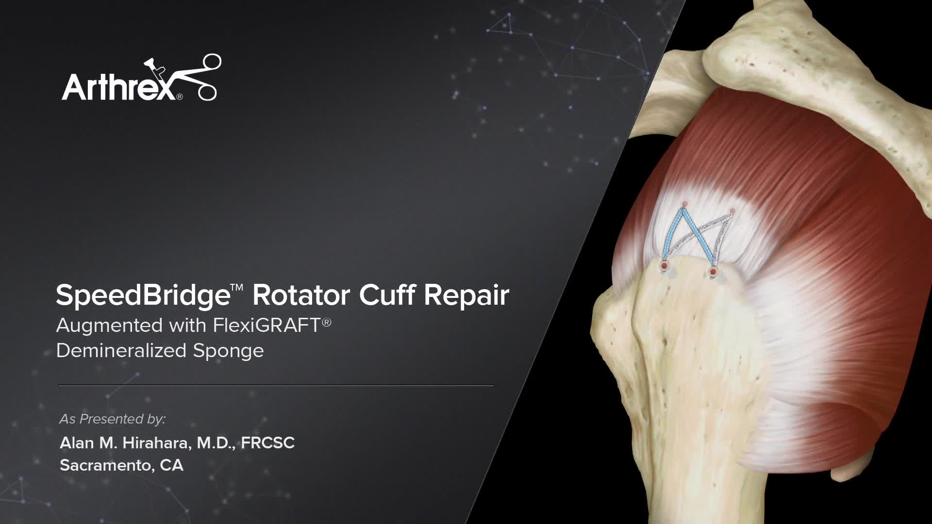 Arthrex - SpeedBridge™ Rotator Cuff Repair Augmented with