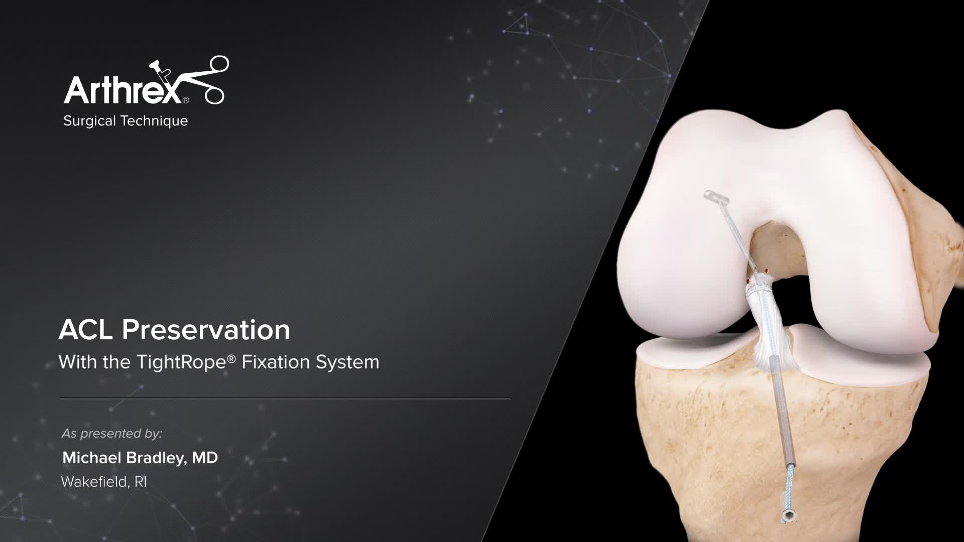 Arthrex Acl Preservation With The Tightrope® Fixation System