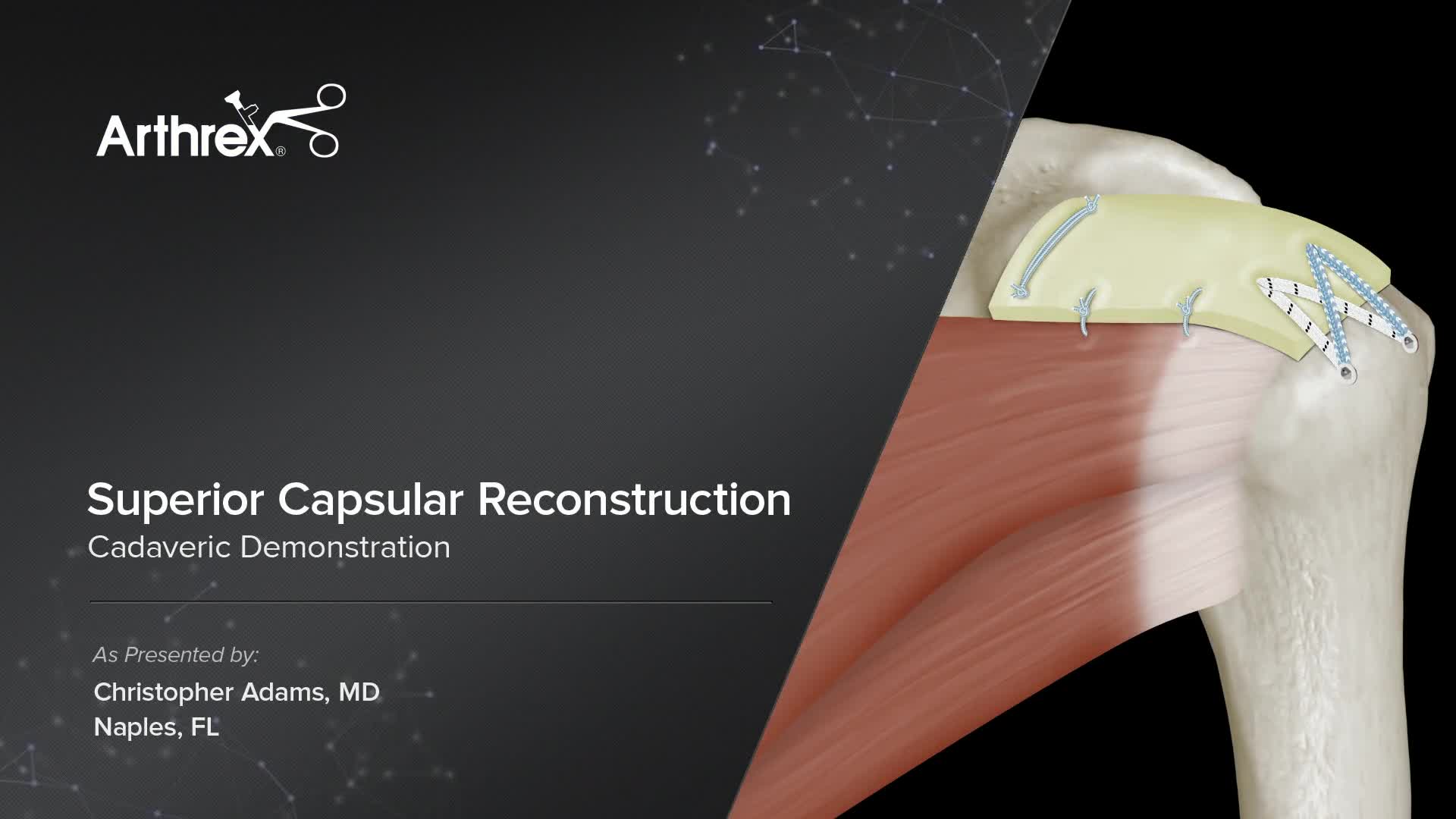 Arthrex - Superior Capsular Reconstruction Cadaveric Demonstration