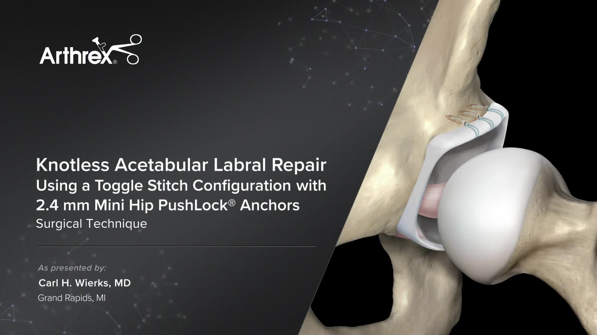 Arthrex Knotless Acetabular Labral Repair Using A Toggle Stitch Configuration With Mm Mini