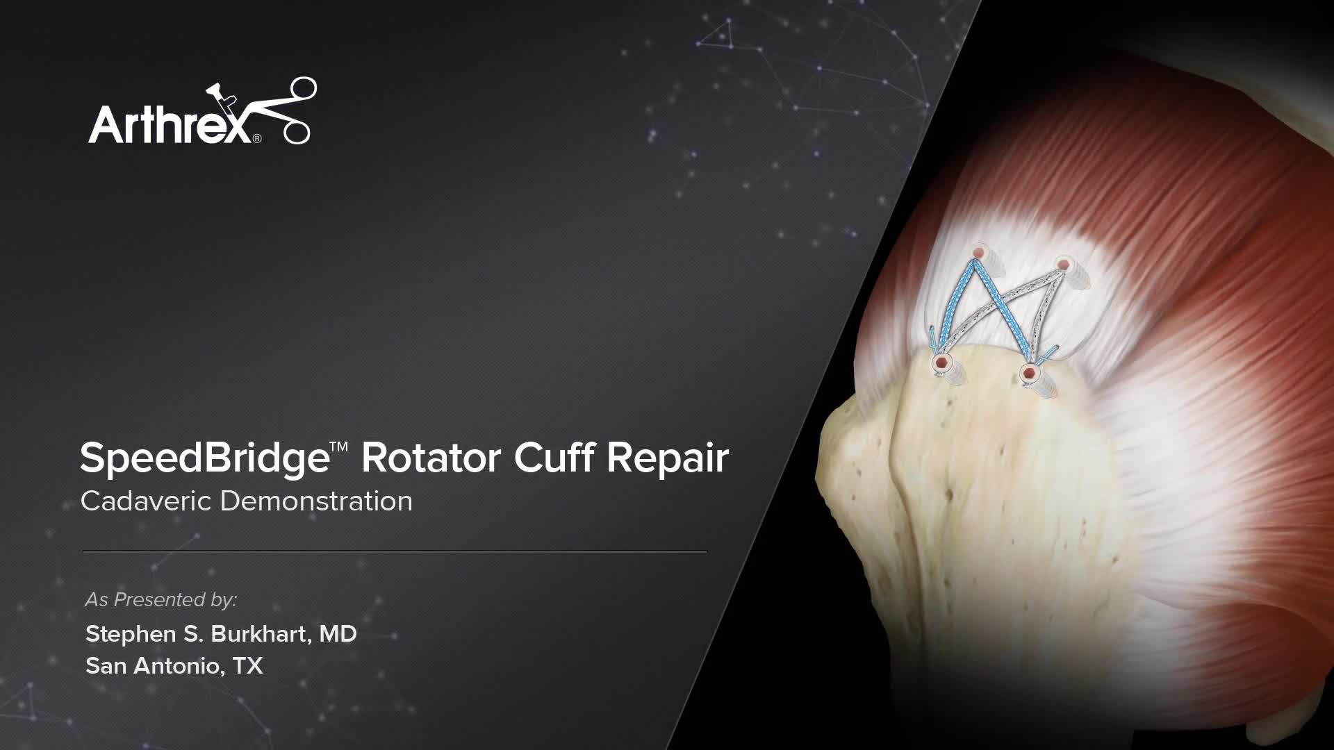 Arthrex - Speedbridge™ Rotator Cuff Repair Cadaveric Demonstration