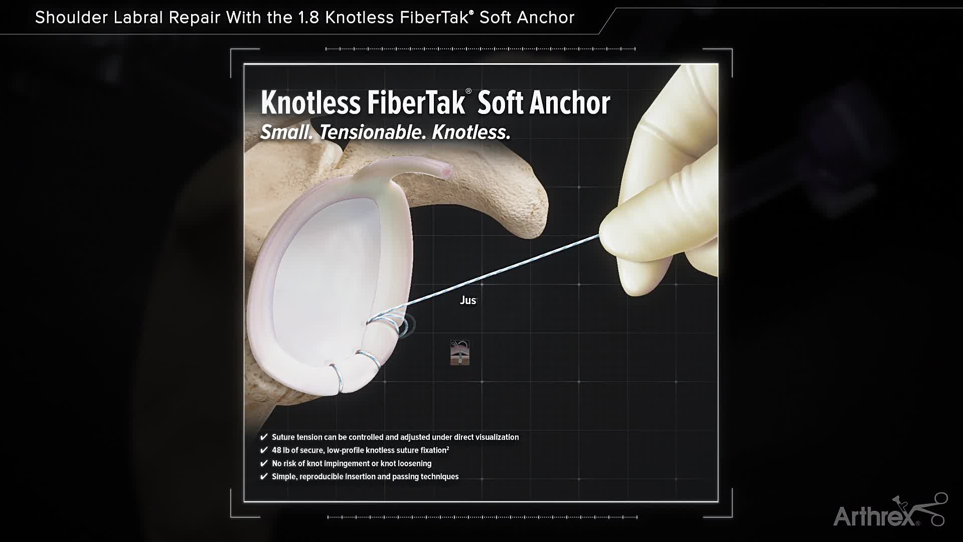 Arthrex Shoulder Labral Repair With The 1 8 Knotless Fibertak® Soft Anchor