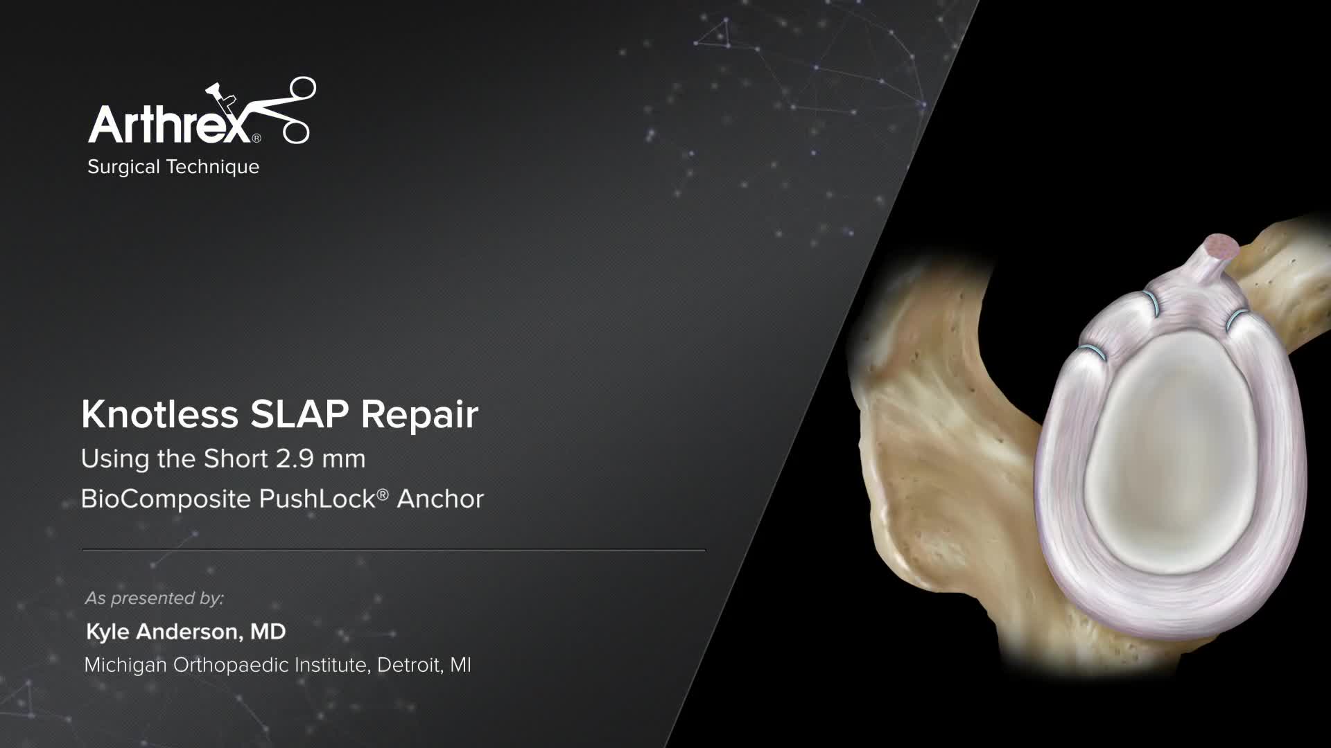 Arthrex Knotless Slap Repair Using The Short 2 9 Mm Biocomposite Pushlock® Anchor