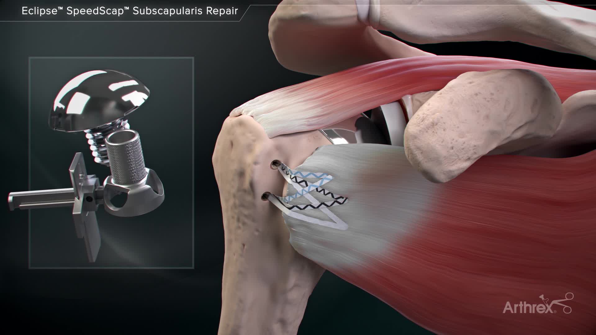 Arthrex - Eclipse™ SpeedScap™ Subscapularis Repair