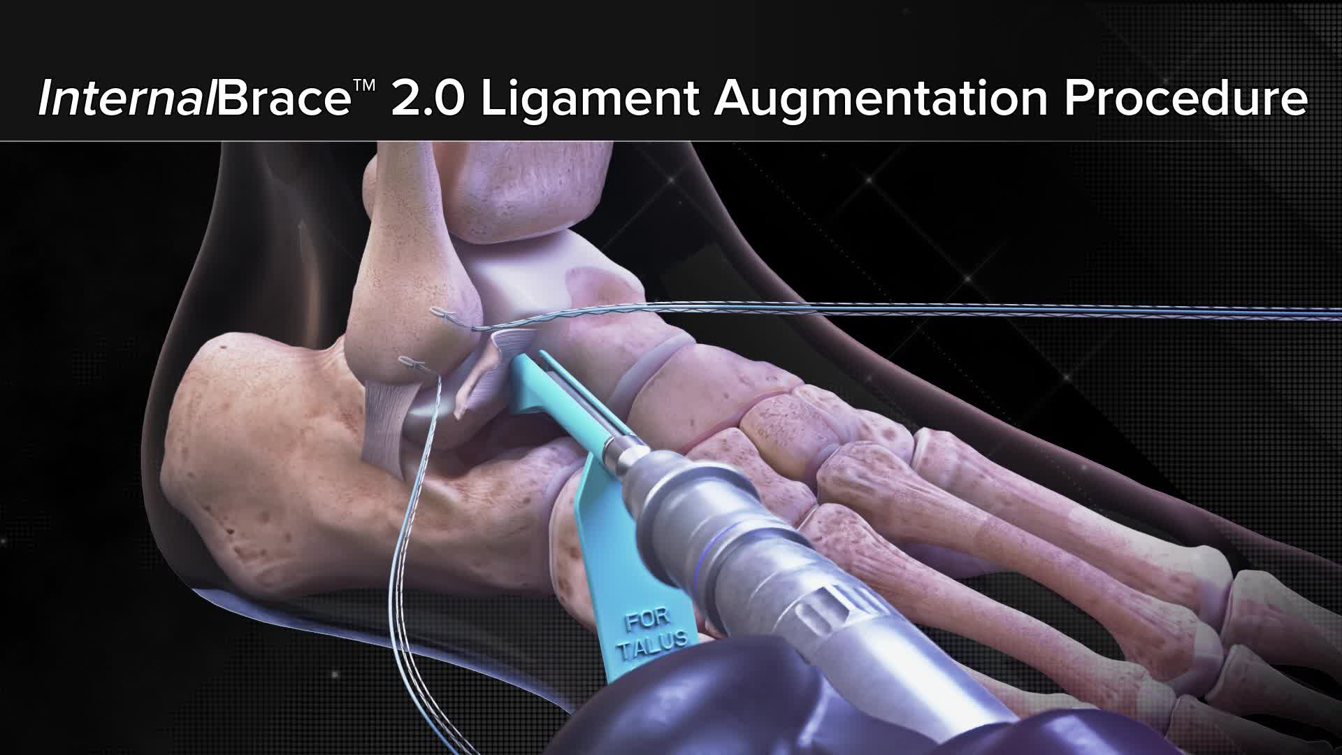 Arthrex Internalbrace Ligament Augmentation Procedure