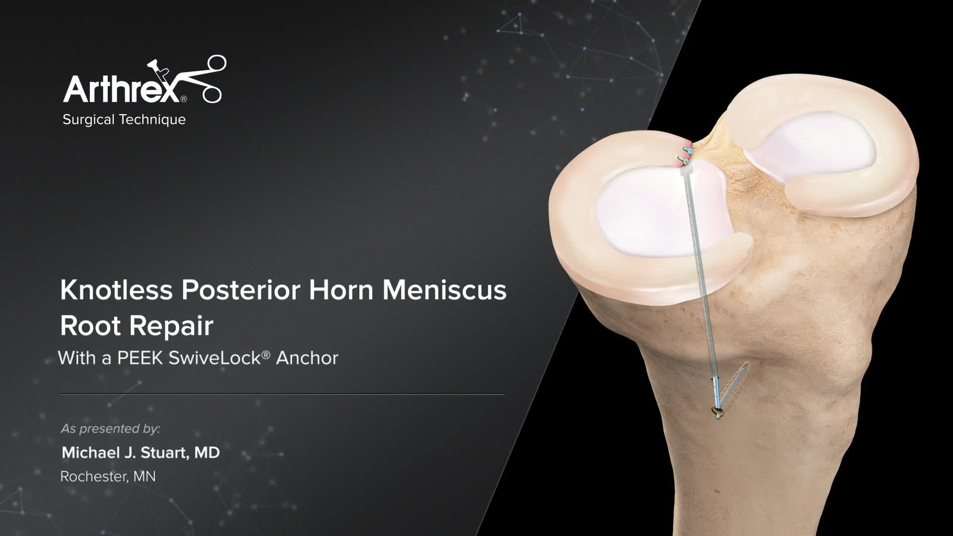 Arthrex - Knotless Posterior Horn Meniscus Root Repair With a PEEK ...