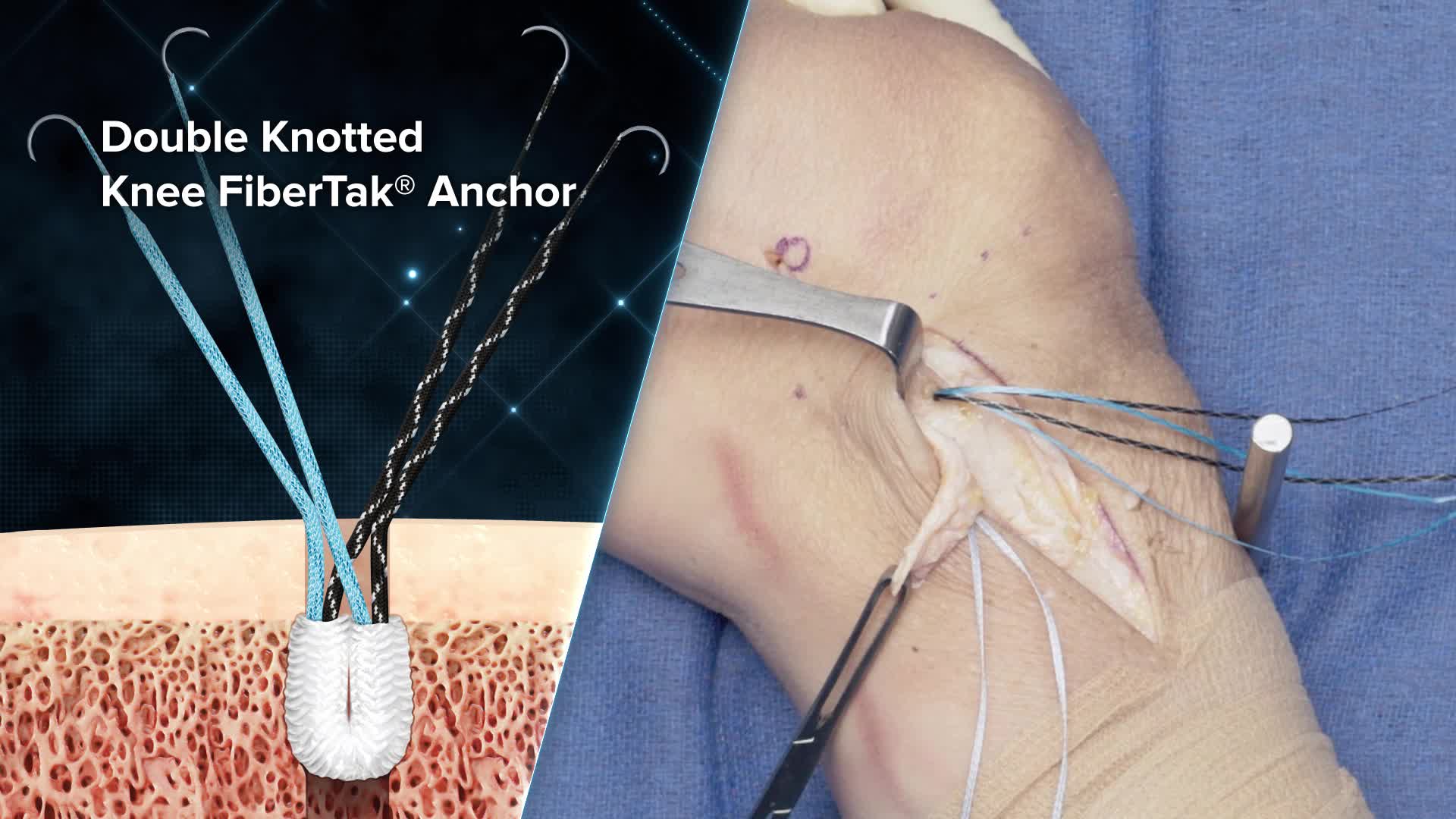 Arthrex Double Knotted Knee Fibertak Anchor Product Demonstration