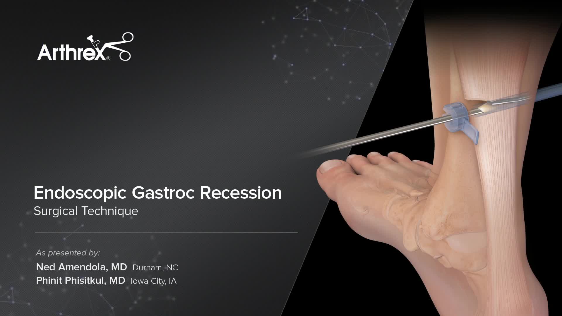 Arthrex Endoscopic Plantar Fascia