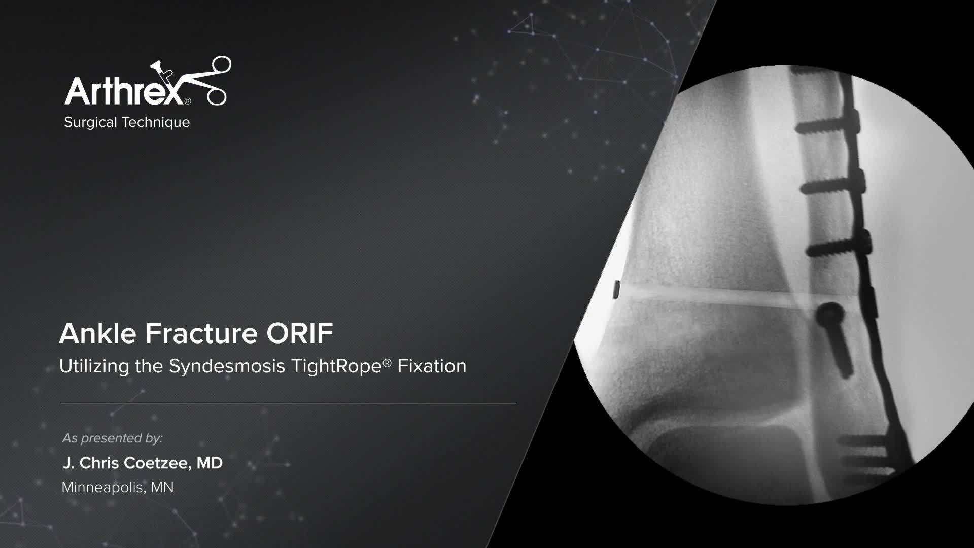 Arthrex - Ankle Fracture ORIF Utilizing the Syndesmosis TightRope® Fixation