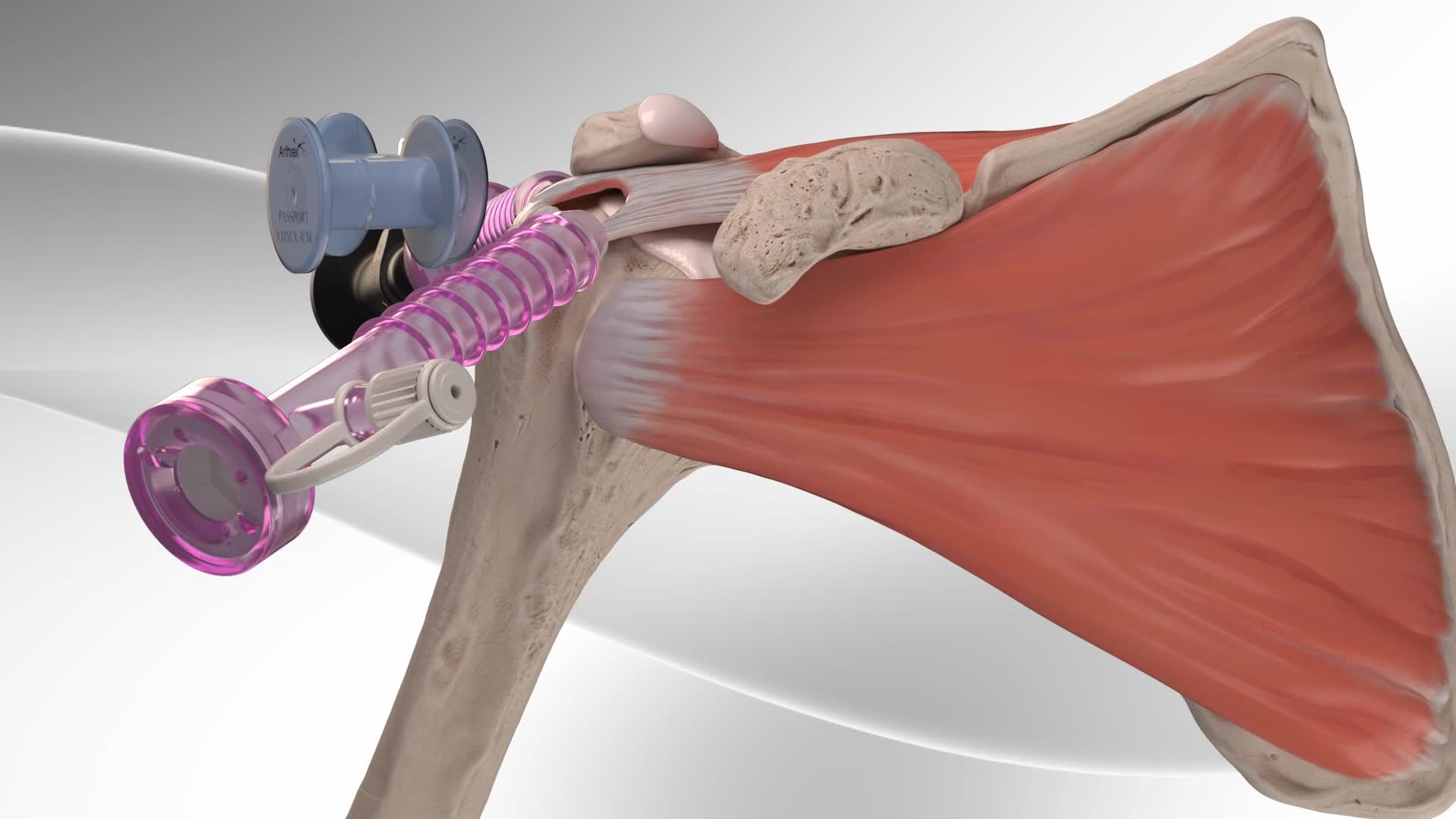 Arthrex Knotless Rotator Cuff Repair