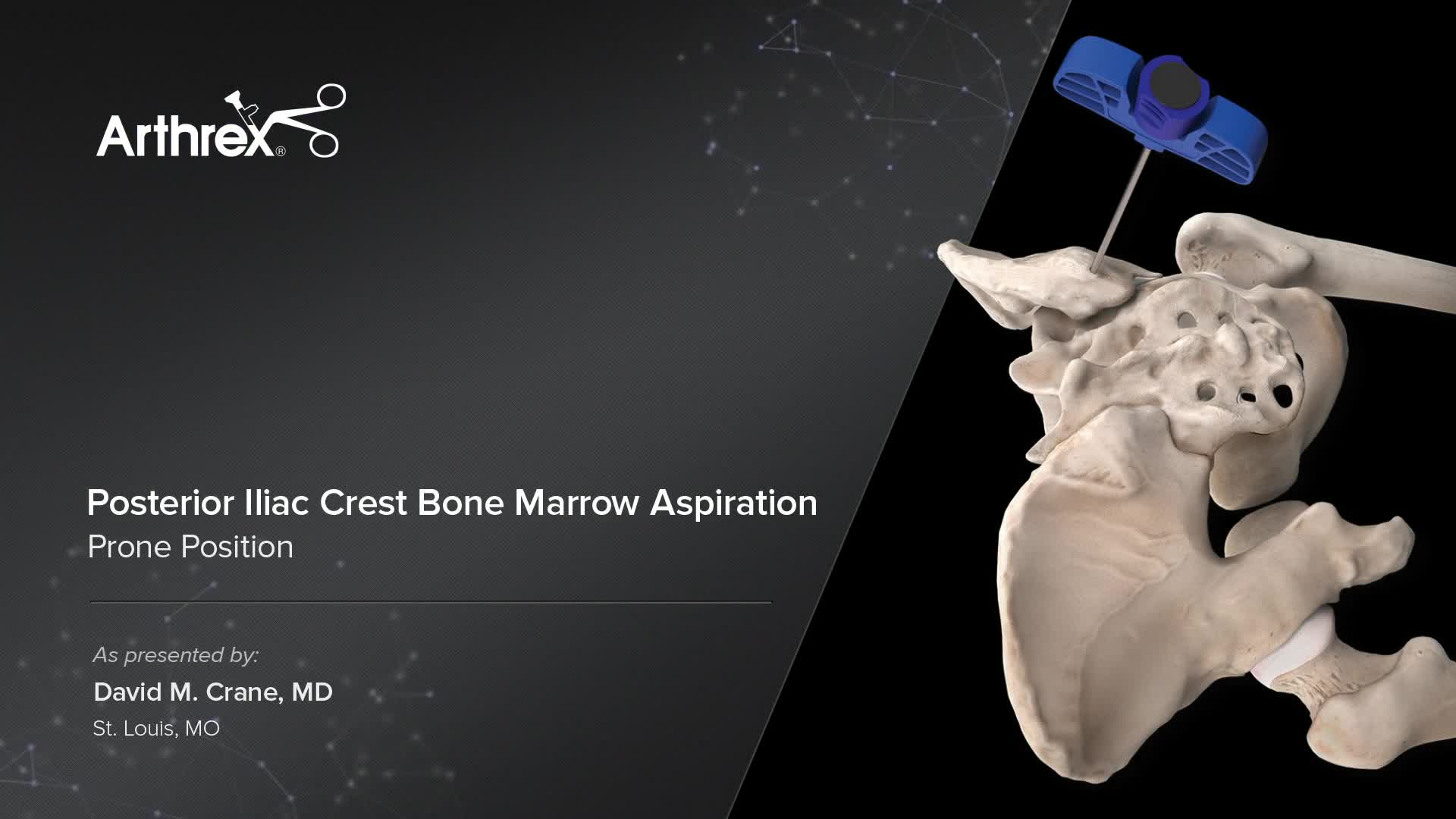 Arthrex - Posterior Iliac Crest Bone Marrow Aspiration - Prone Position