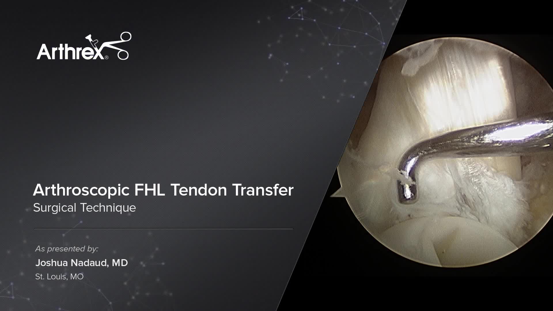 Arthrex - Fhl Tendon Transfer