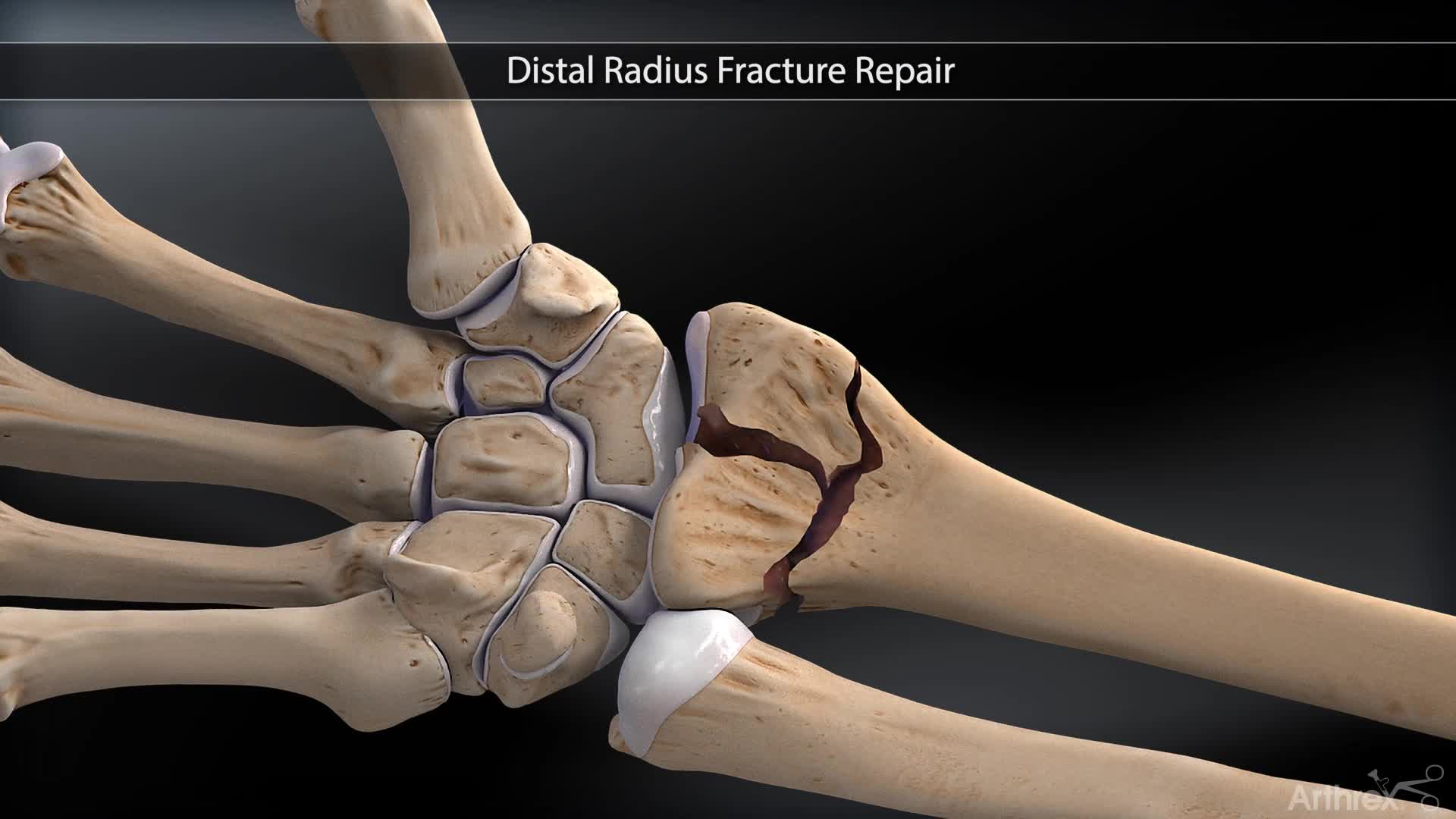 radius fracture