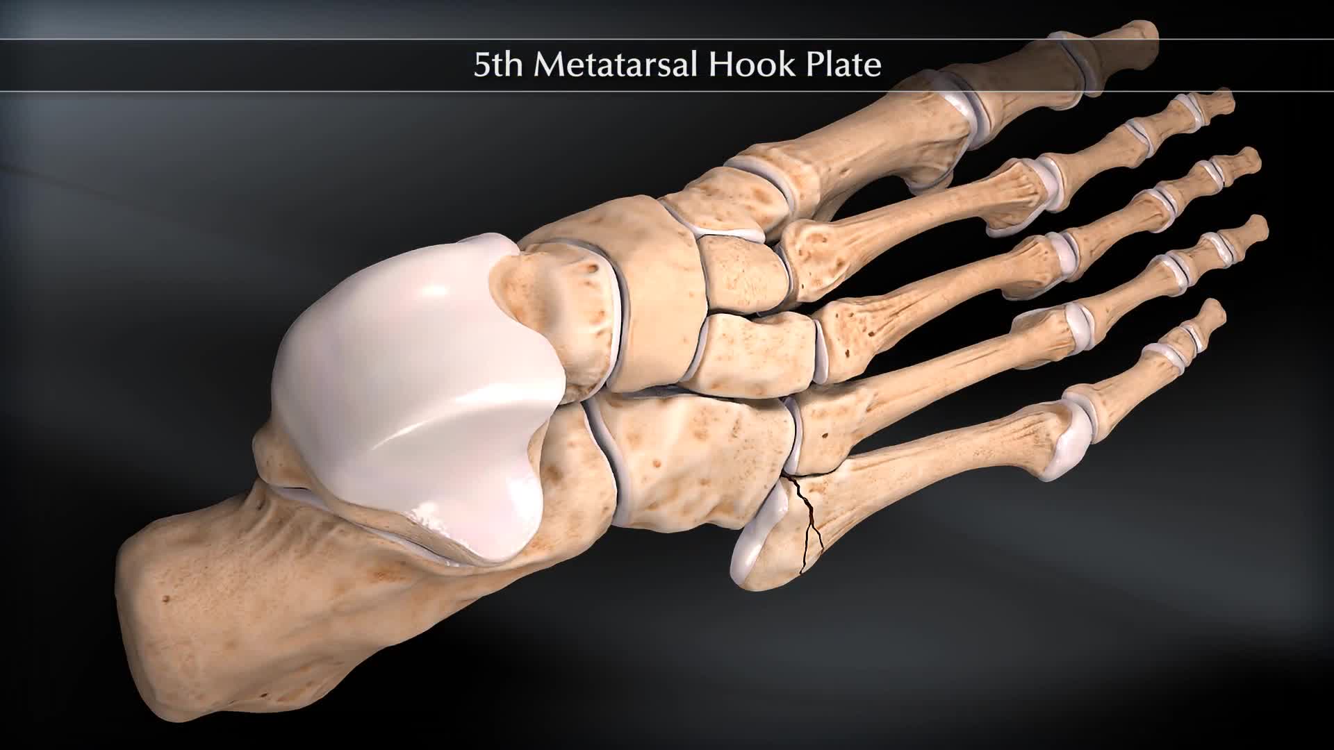 Arthrex - 5th Metatarsal Fracture System