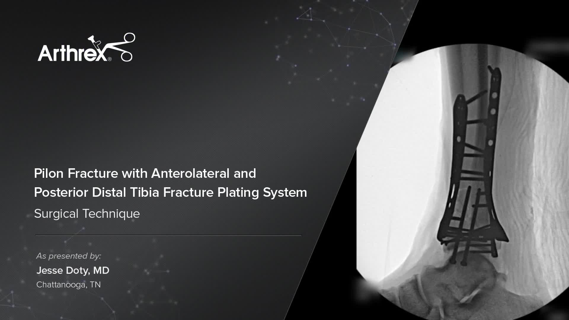 Arthrex - Internal Fixation For Distal Tibia Fracture/Pilon