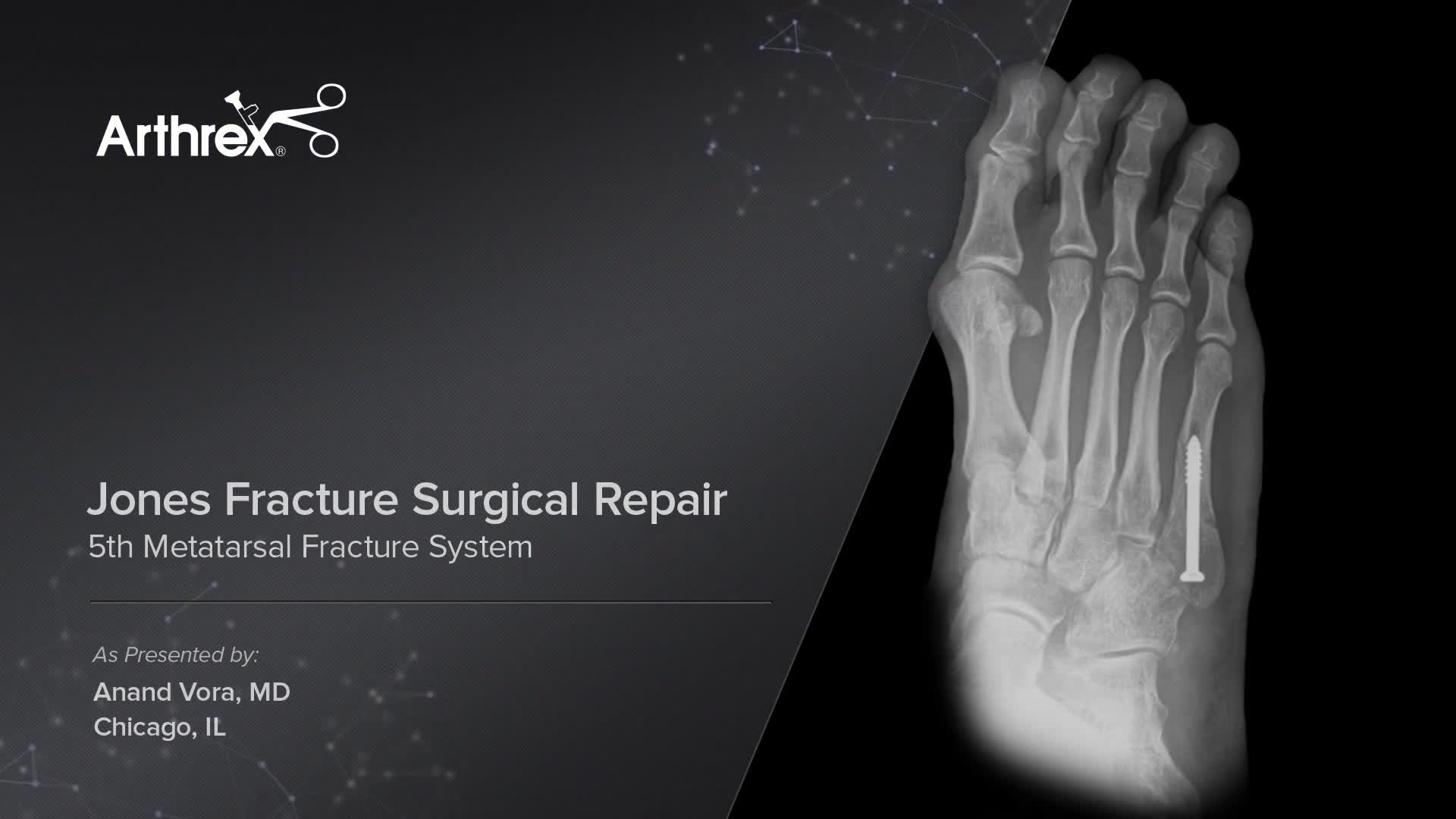 Arthrex Metatarsal Fracture Repair