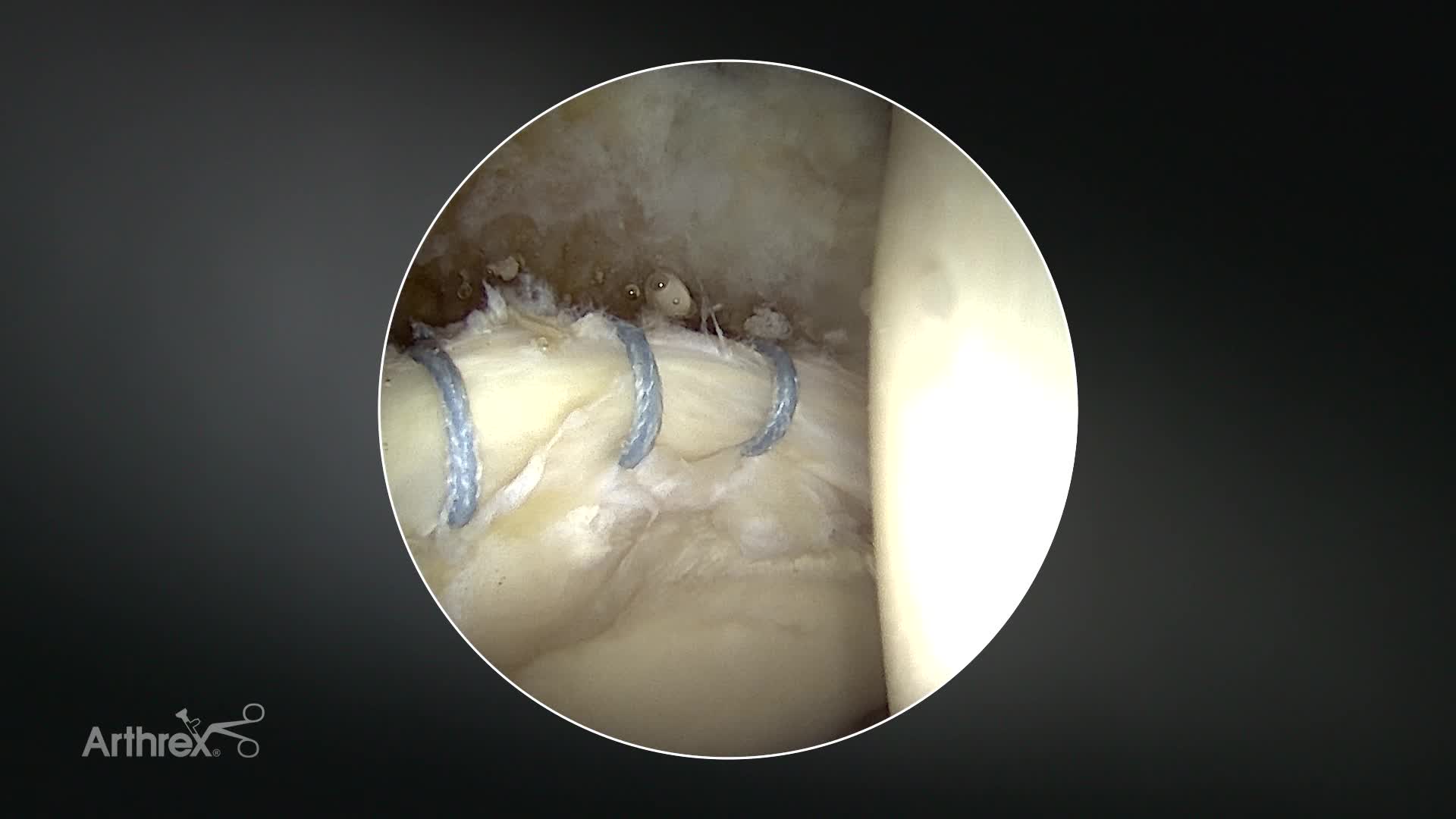 Arthrex - Acetabular Labral Repair Using the 2.4 mm Knotless Hip ...