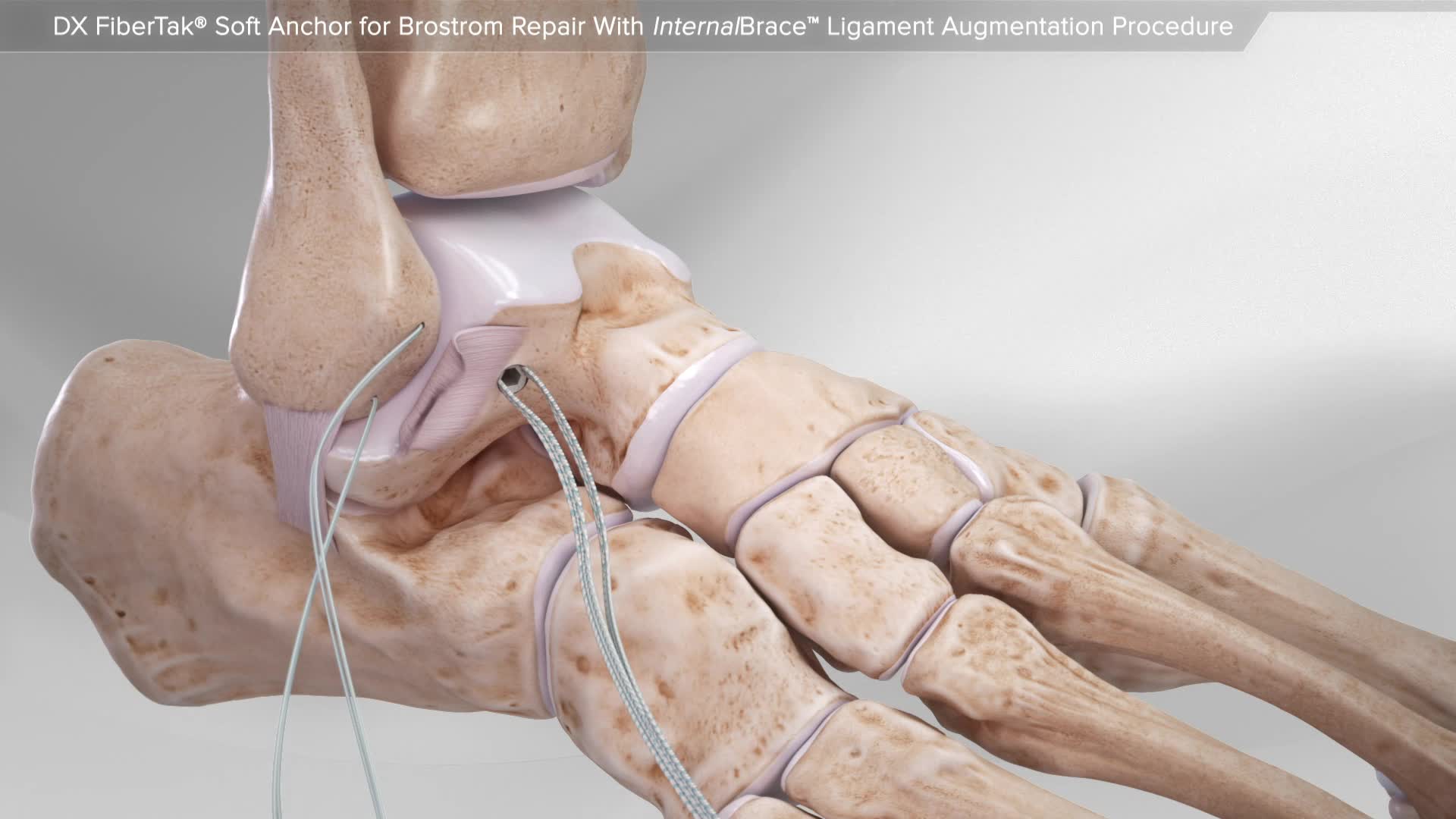 Arthrex Dx Fibertak Soft Anchor For Brostrom Repair With Internalbrace Ligament Augmentation