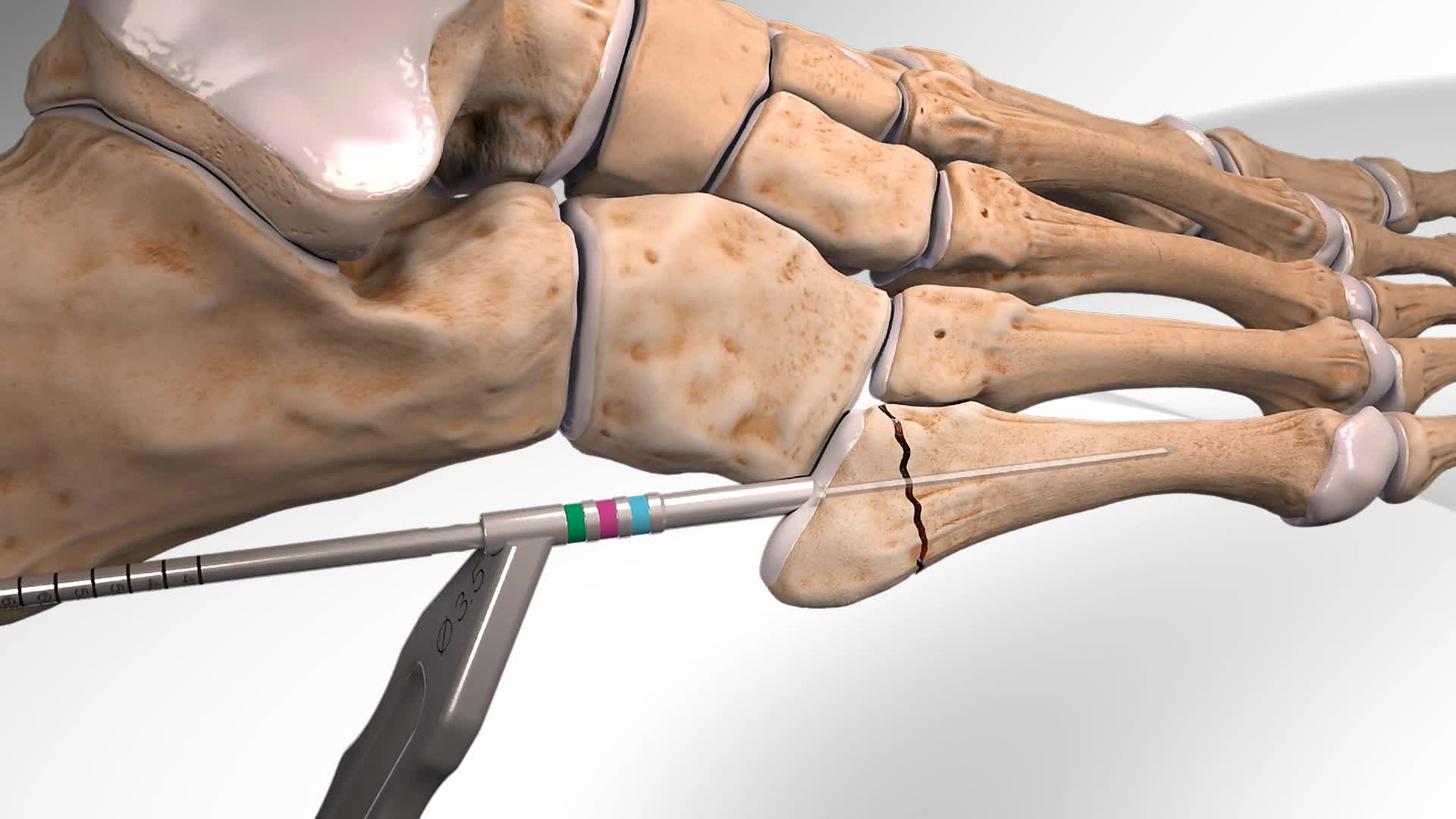 Arthrex - Metatarsal Fracture Repair