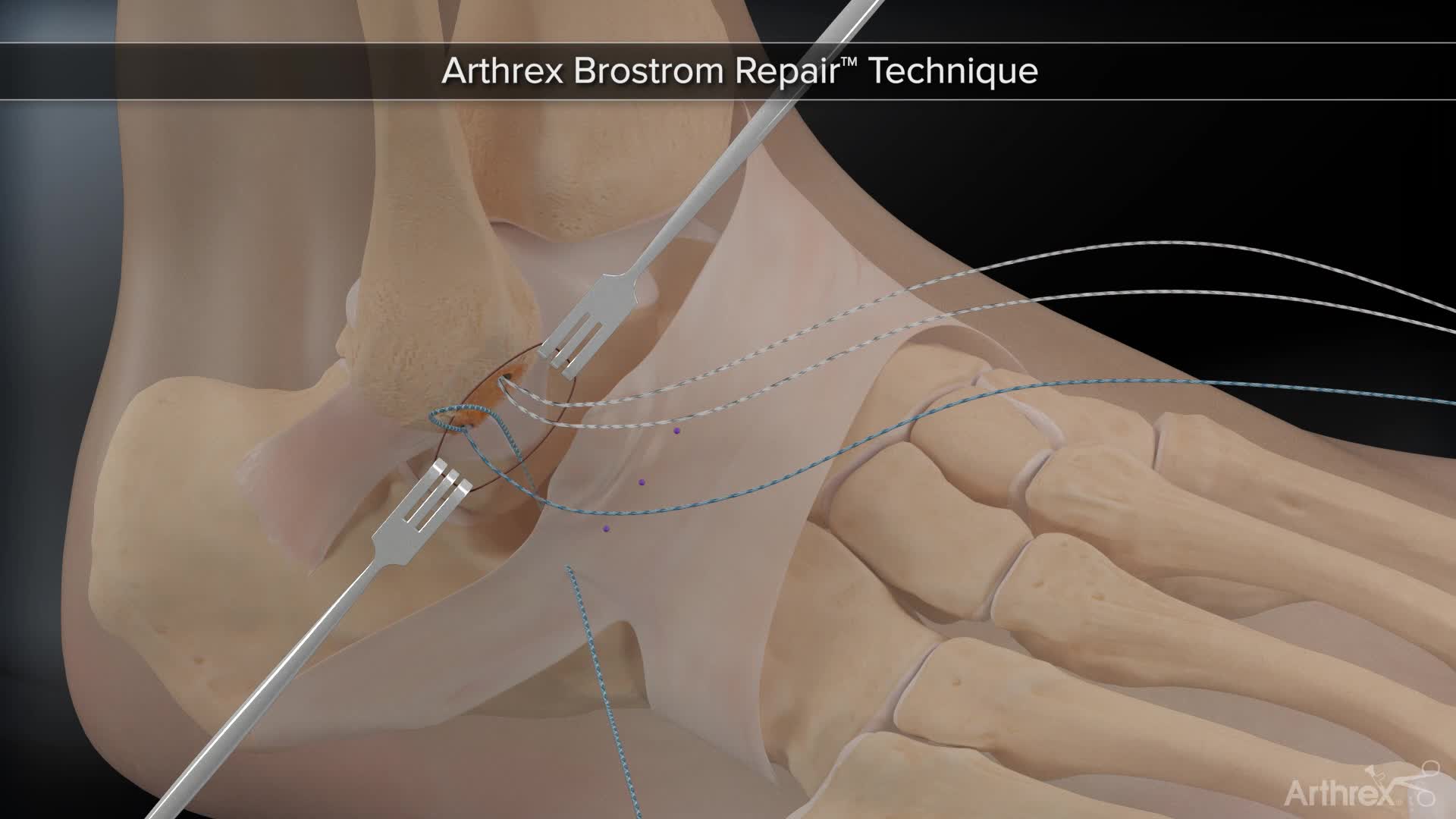 Arthrex - ArthroBrostrom®