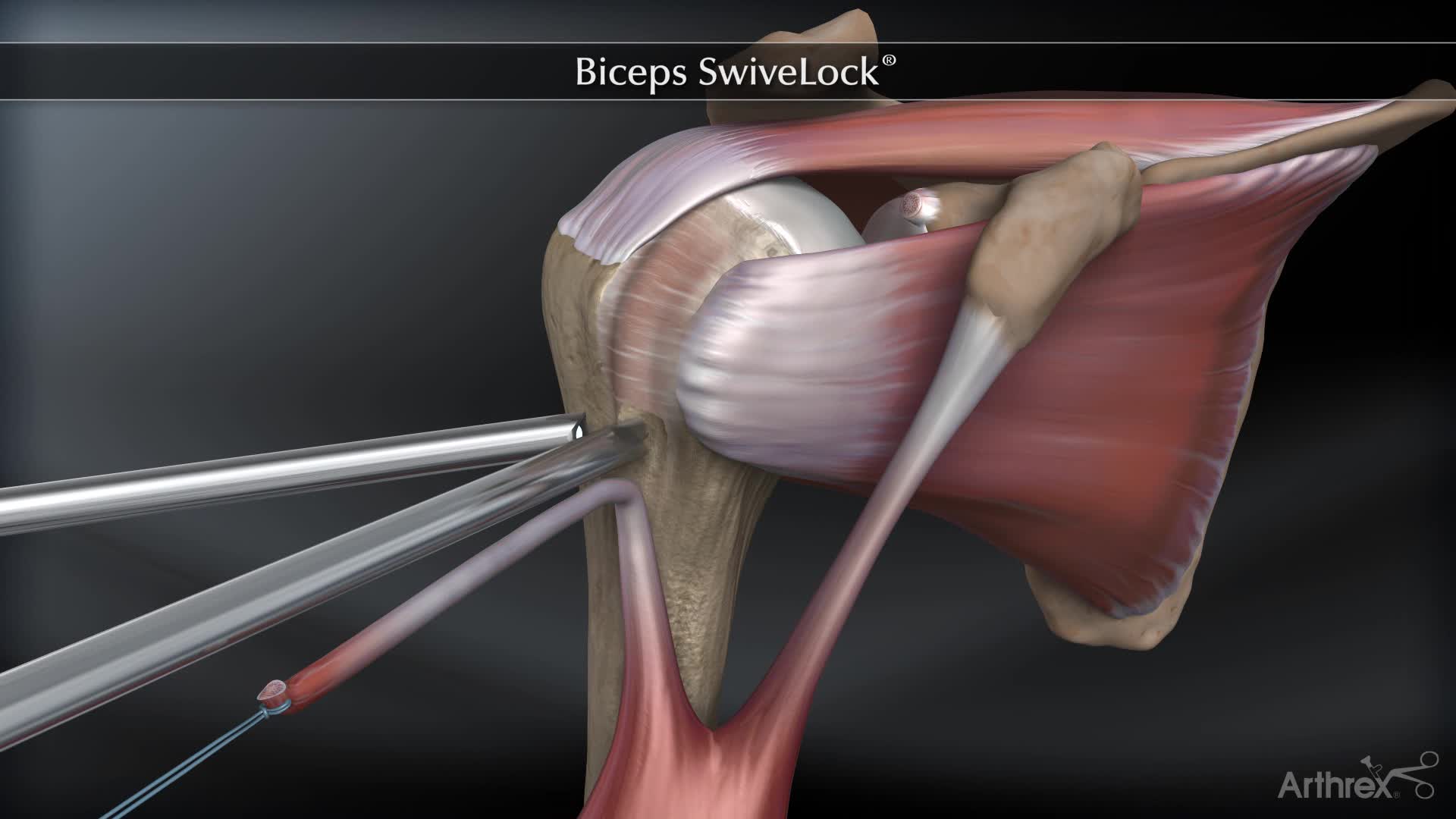 Arthrex Swivelock® Tenodesis Technique