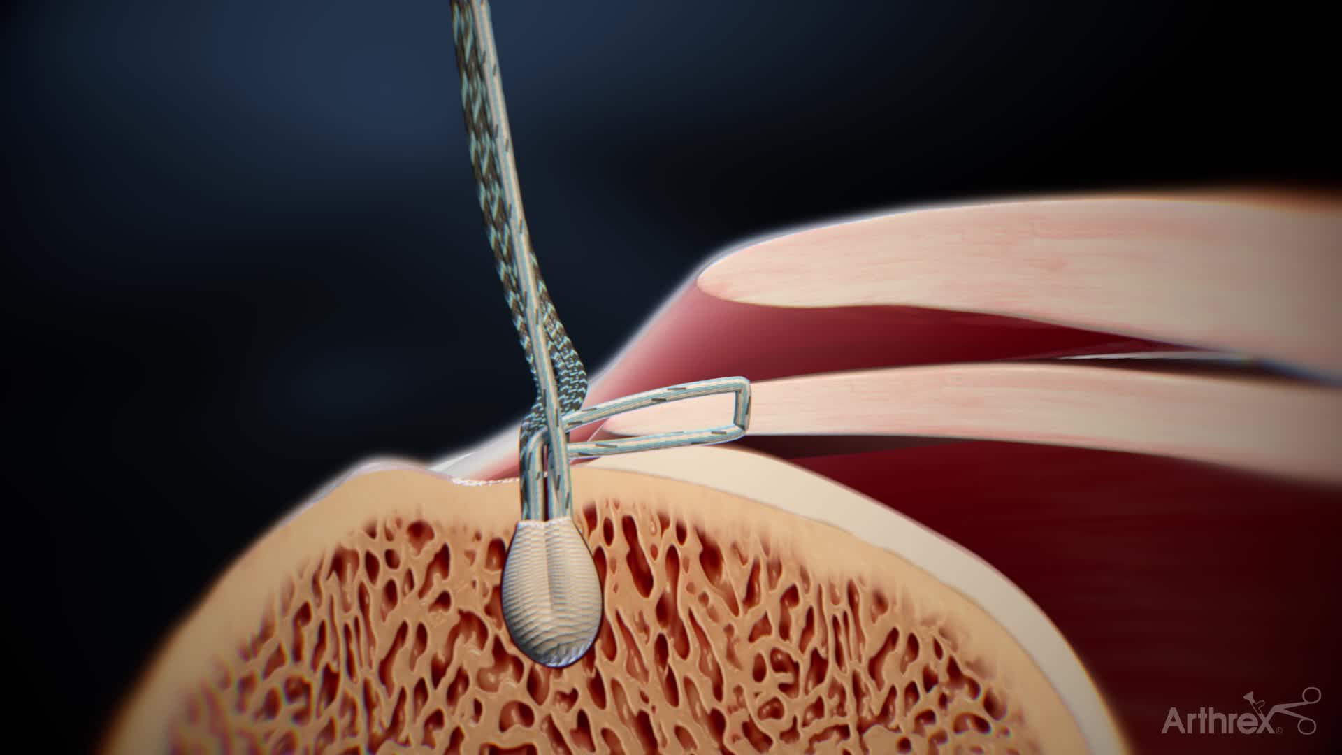 Arthrex - Delaminated Rotator Cuff Repair Surgical Technique Animation