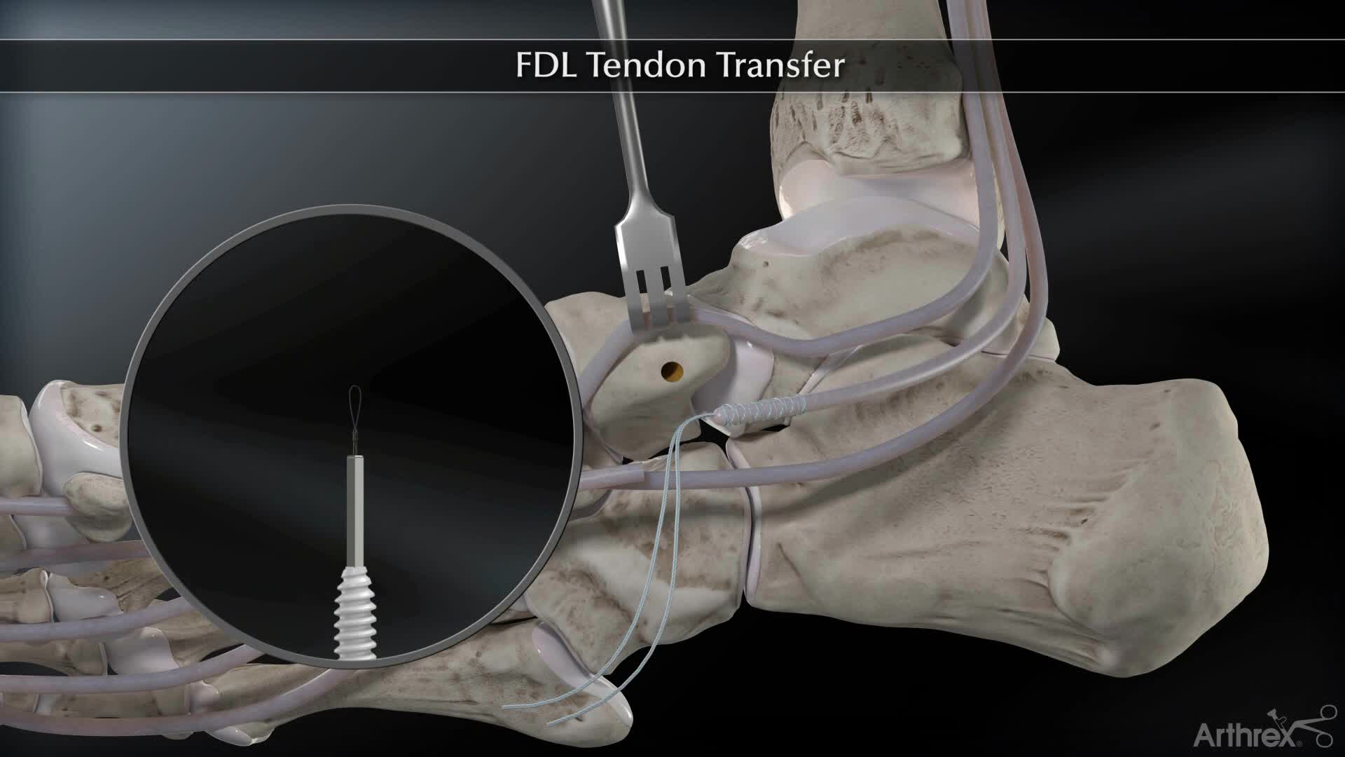 arthrex-flexor-digitorum-longus-fdl-tendon-transfer