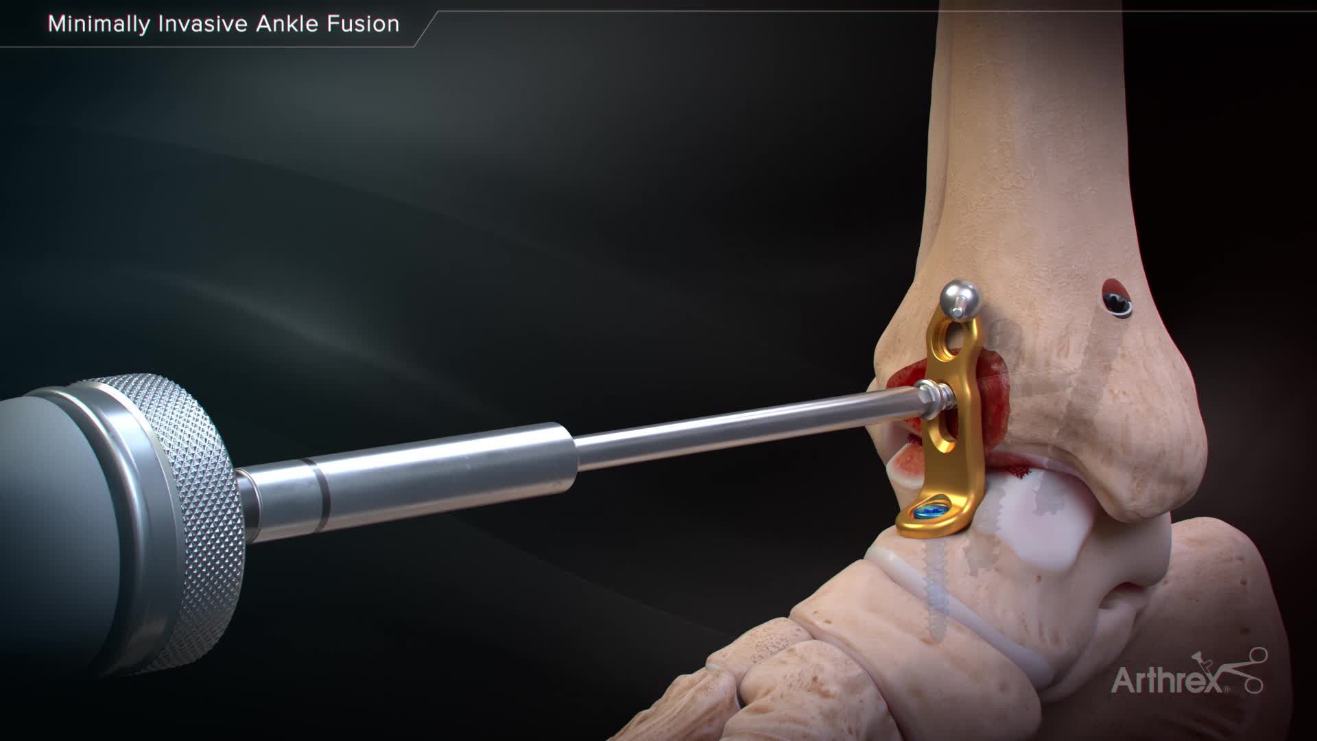 arthrex-minimally-invasive-ankle-fusion