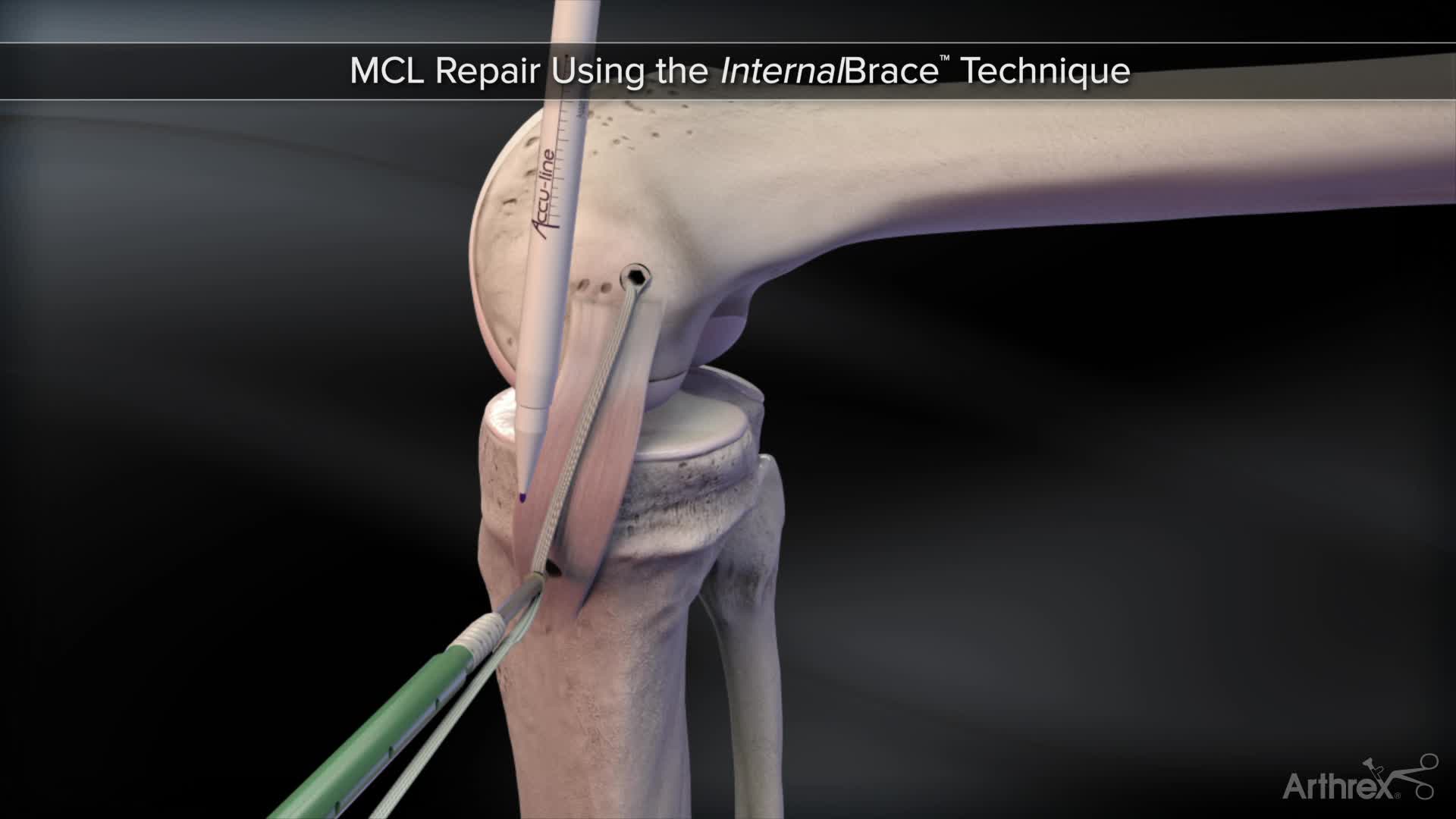 Arthrex - InternalBrace™ Procedure For A Medial Collateral Ligament ...