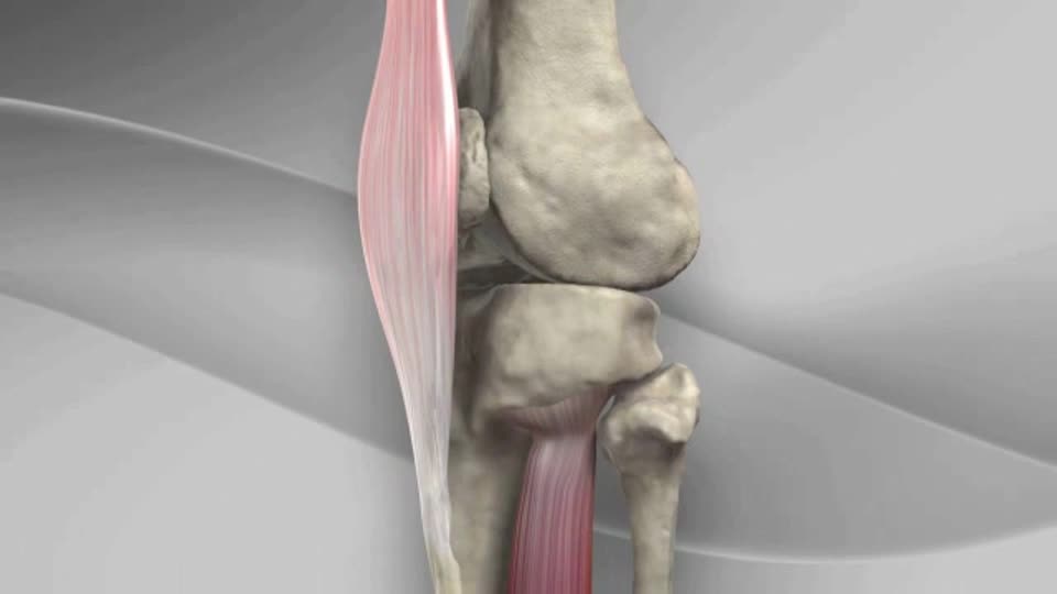 Arthrex - Osteotomie Van Een Tuberositas Tibiae Met Het T3® Amz Systeem