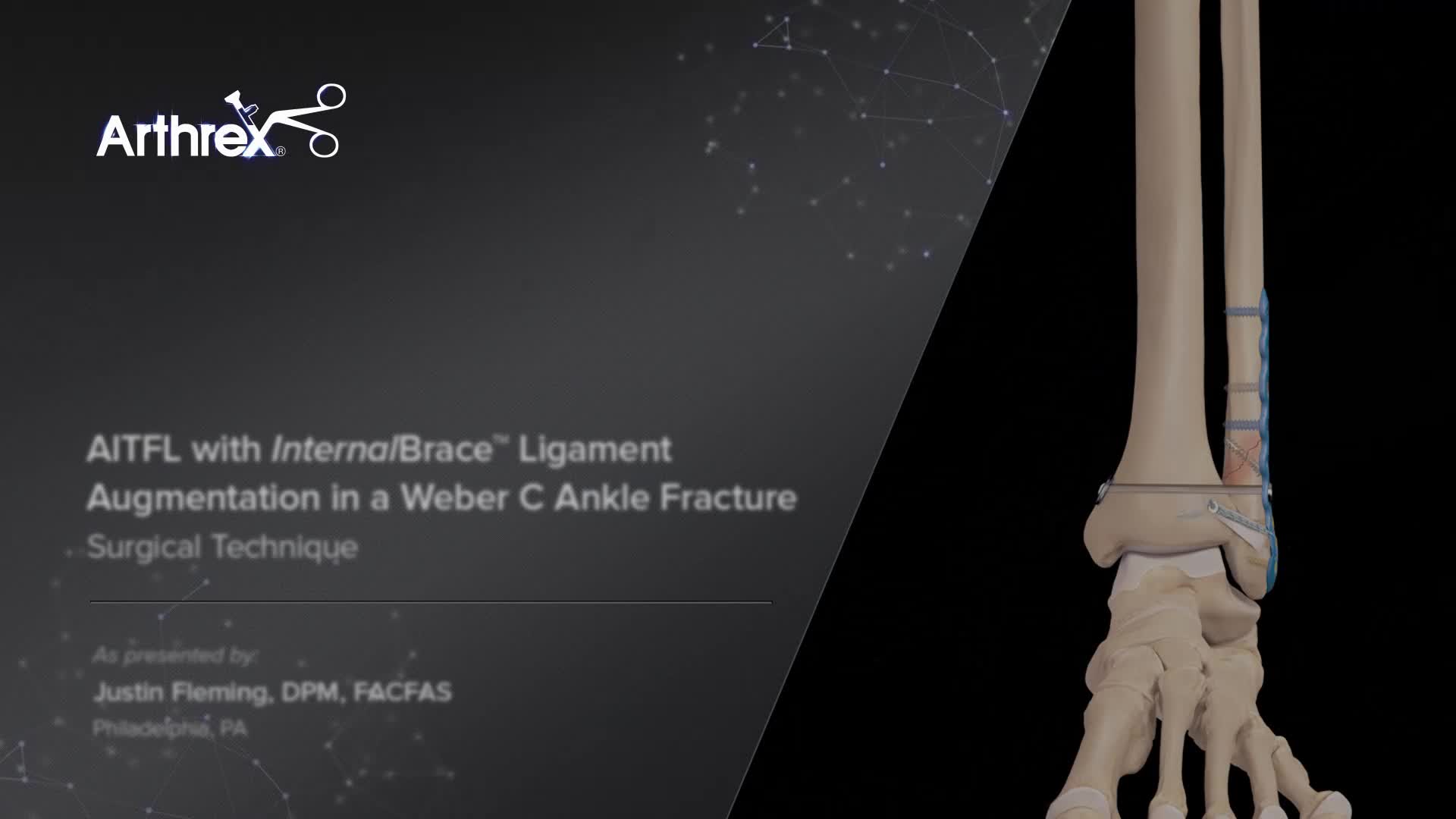 Arthrex - AITFL Repair With InternalBrace™ Ligament Augmentation ...