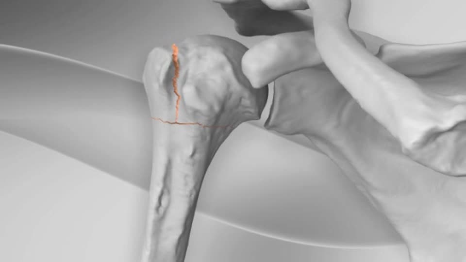 Arthrex Proximal Humerus Fracture Repair With Sutureplate Technique