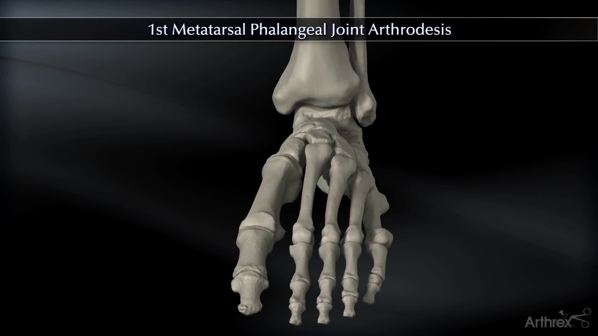 metatarsal-phalangeal-joint-anatomy-hot-sex-picture